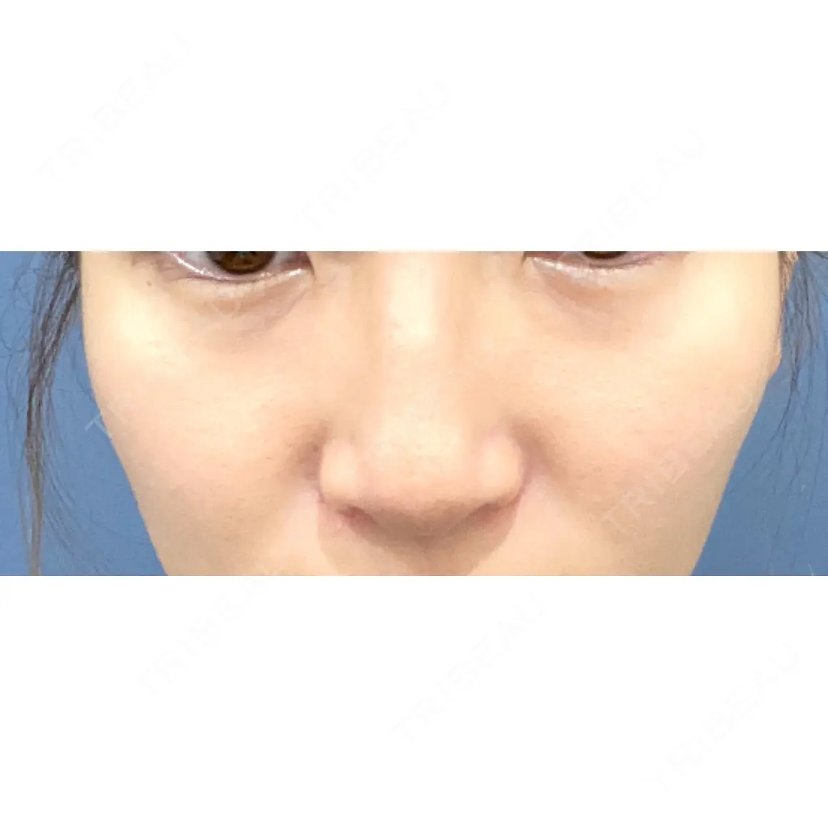 鼻尖形成（切開） / クマ治療 / 軟骨移植 / ワシ鼻修正・ハンプ切除 / 眉間プロテーゼ / 鼻柱挙上 / ボトックス（口角） / ヒアルロン酸注入（鼻翼基部） / その他（鼻） グローバルビューティークリニック 東京院 AFTER