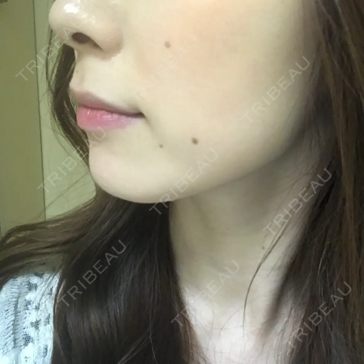 ボトックス（エラ・小顔） 湘南美容クリニック 新宿本院 AFTER