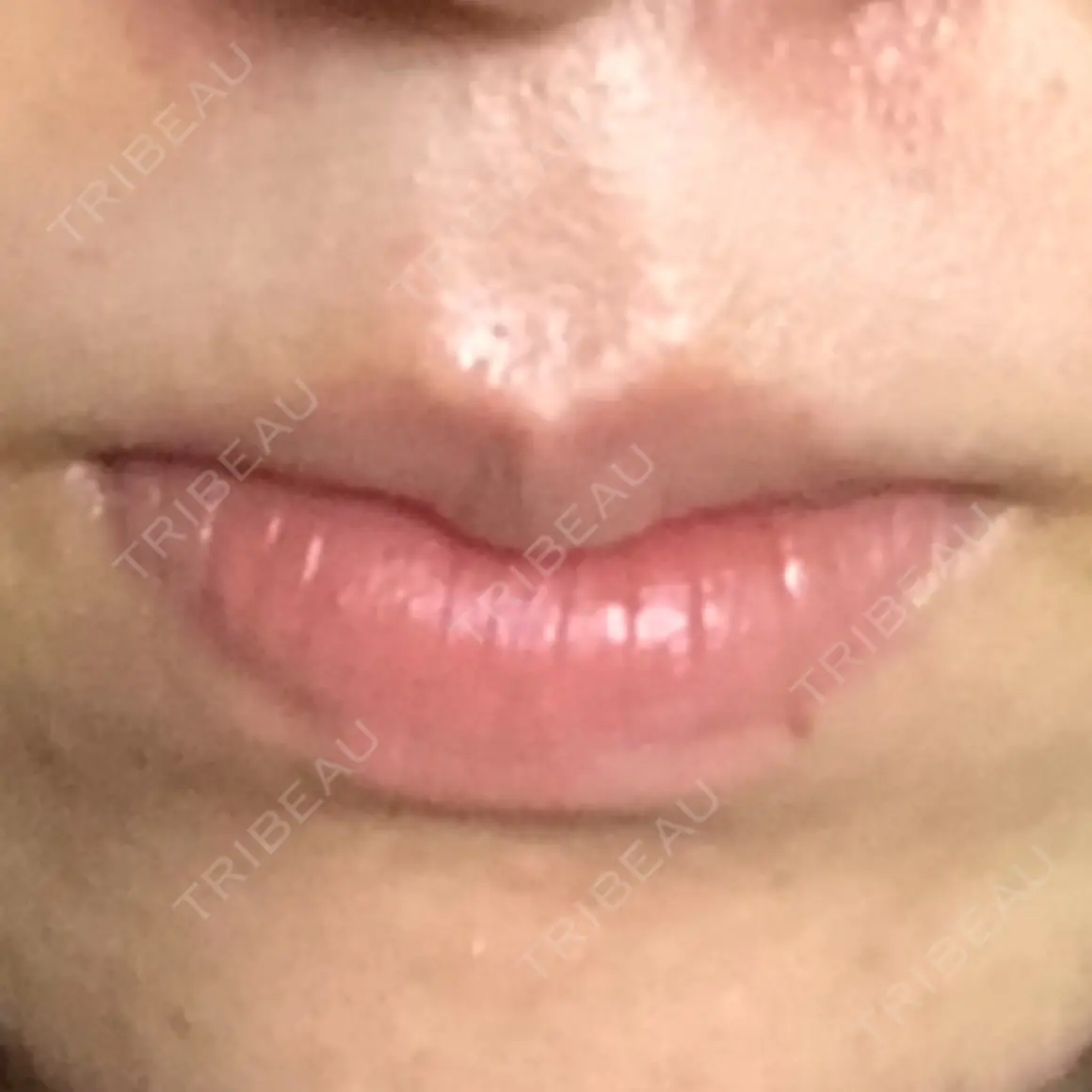 口唇縮小術 宇都宮竹内クリニック AFTER