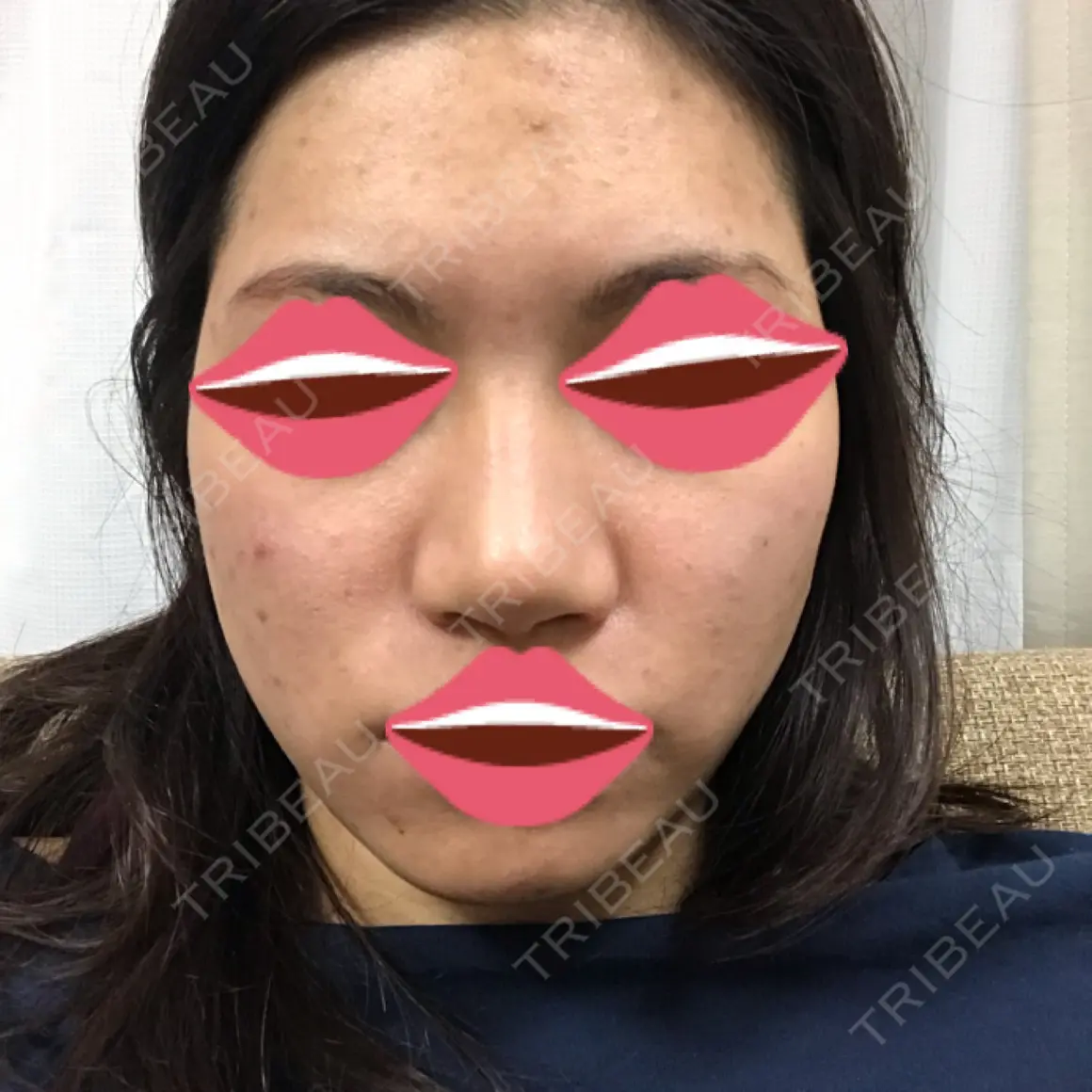 鼻尖形成（切開） / 小鼻縮小（切開） / 骨切幅寄せ / ワシ鼻修正・ハンプ切除 / 鼻尖縮小 / その他（鼻） ザ・プラス美容外科 AFTER