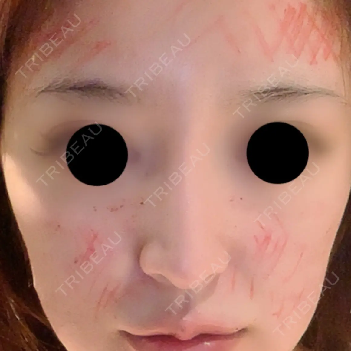 鼻尖形成（切開） / 鼻中隔延長（切開） / 脂肪注入（額） / 脂肪注入（輪郭） ビーザニュー美容整形外科（旧コノピ美容整形外科） AFTER