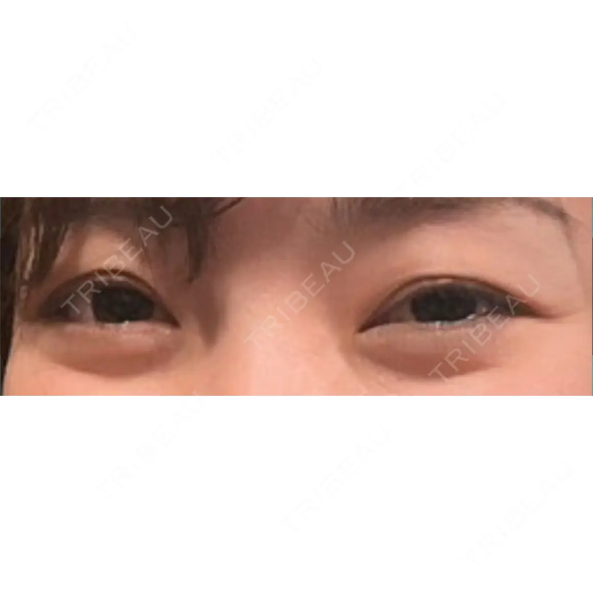 クマ治療 / 下まぶたの脂肪取り 東京シンデレラ美容外科 新宿院 AFTER