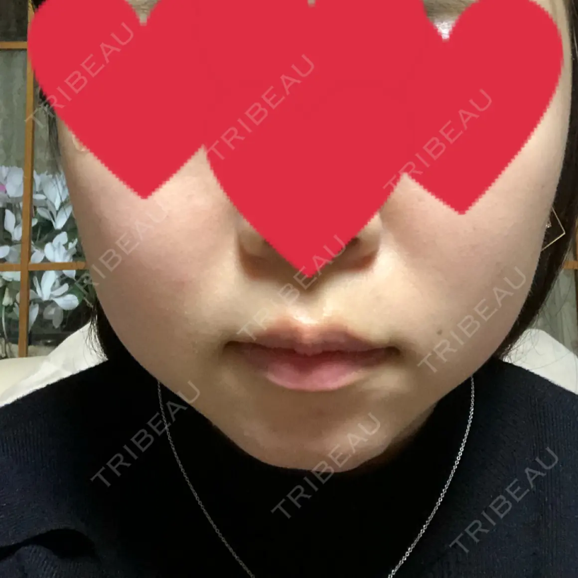 脂肪溶解注射（顔） 湘南美容クリニック 名古屋院 AFTER
