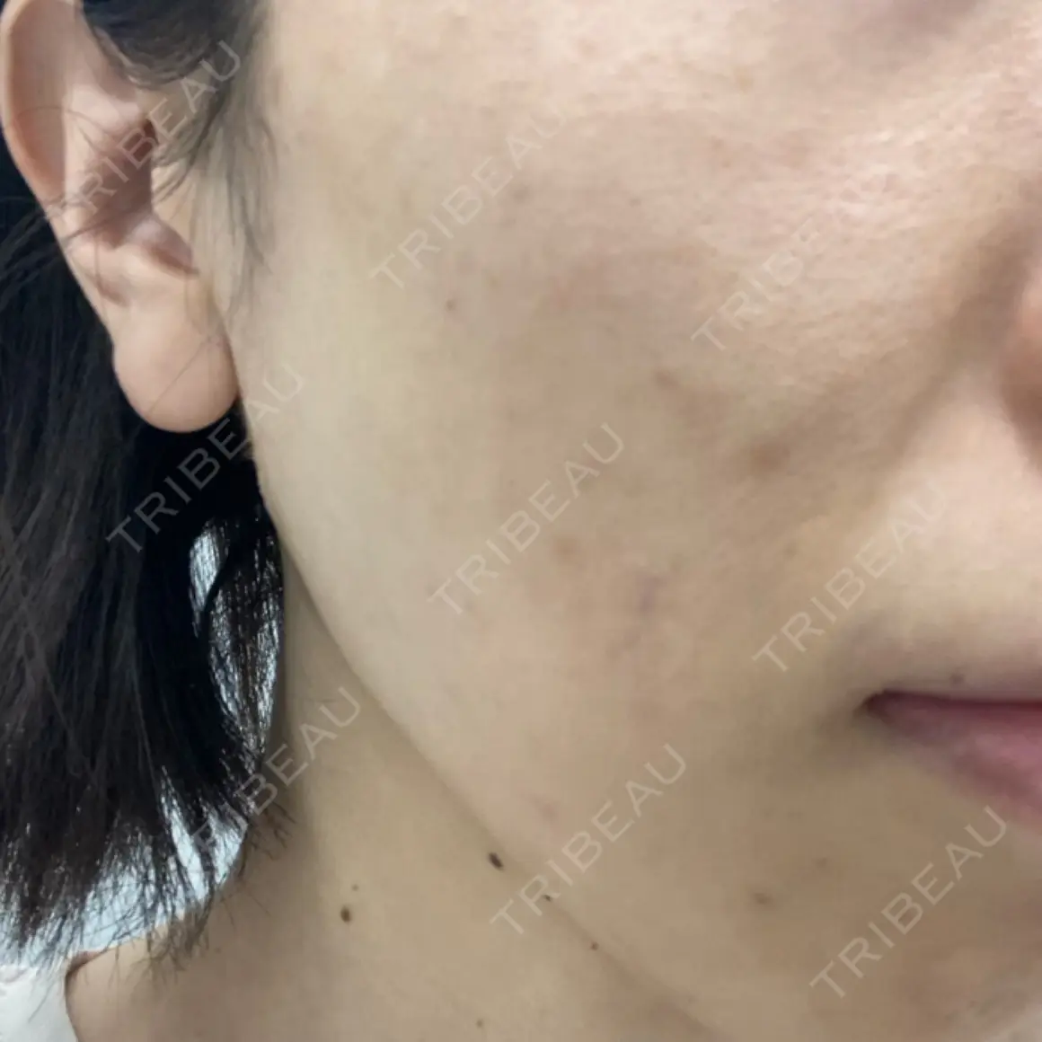 ルメッカ ルラ美容クリニック 新宿院 AFTER