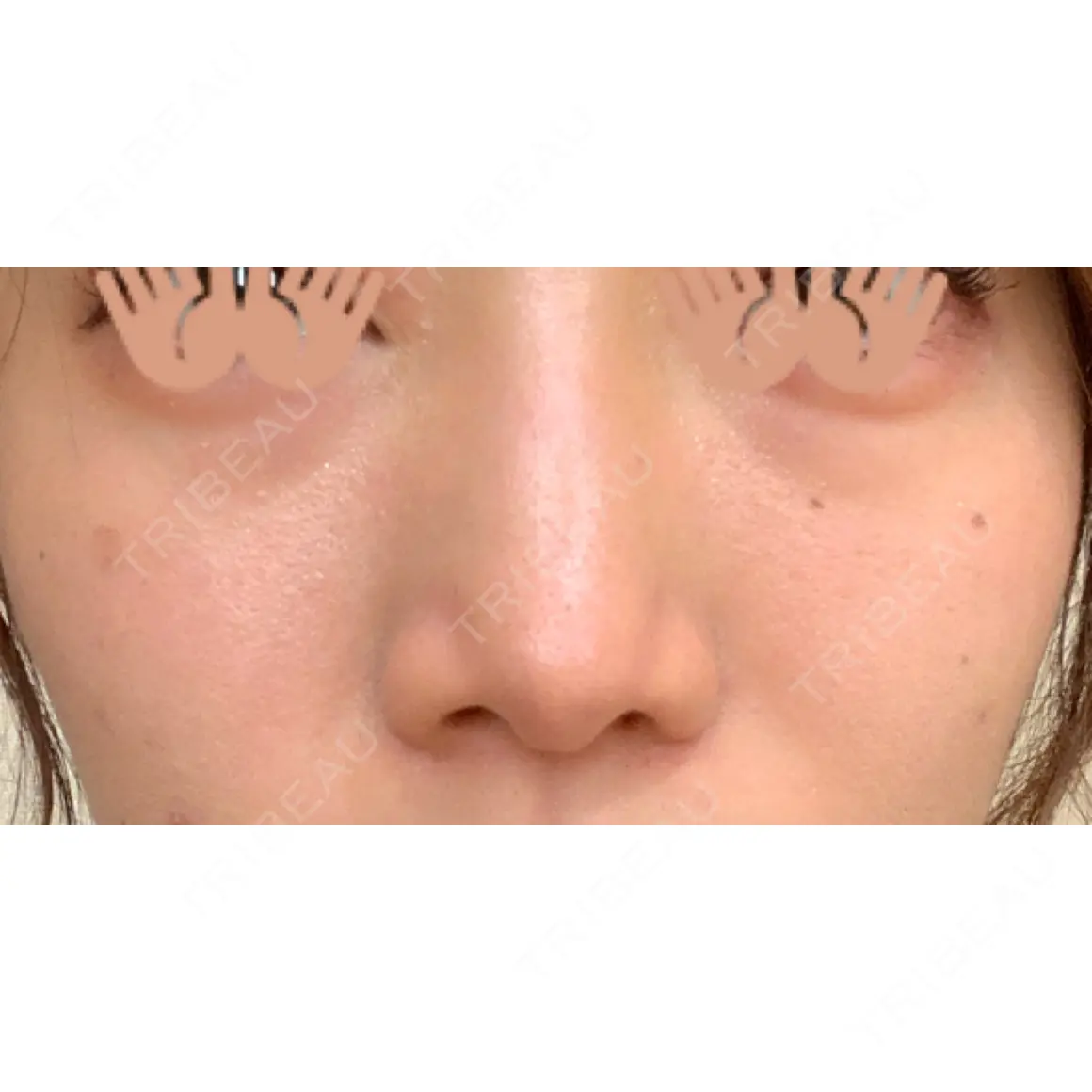 鼻尖形成（切開） / 鼻中隔延長（切開） / 骨切幅寄せ / 眉間プロテーゼ / 鼻修正 NANA（ナナ）美容外科 AFTER