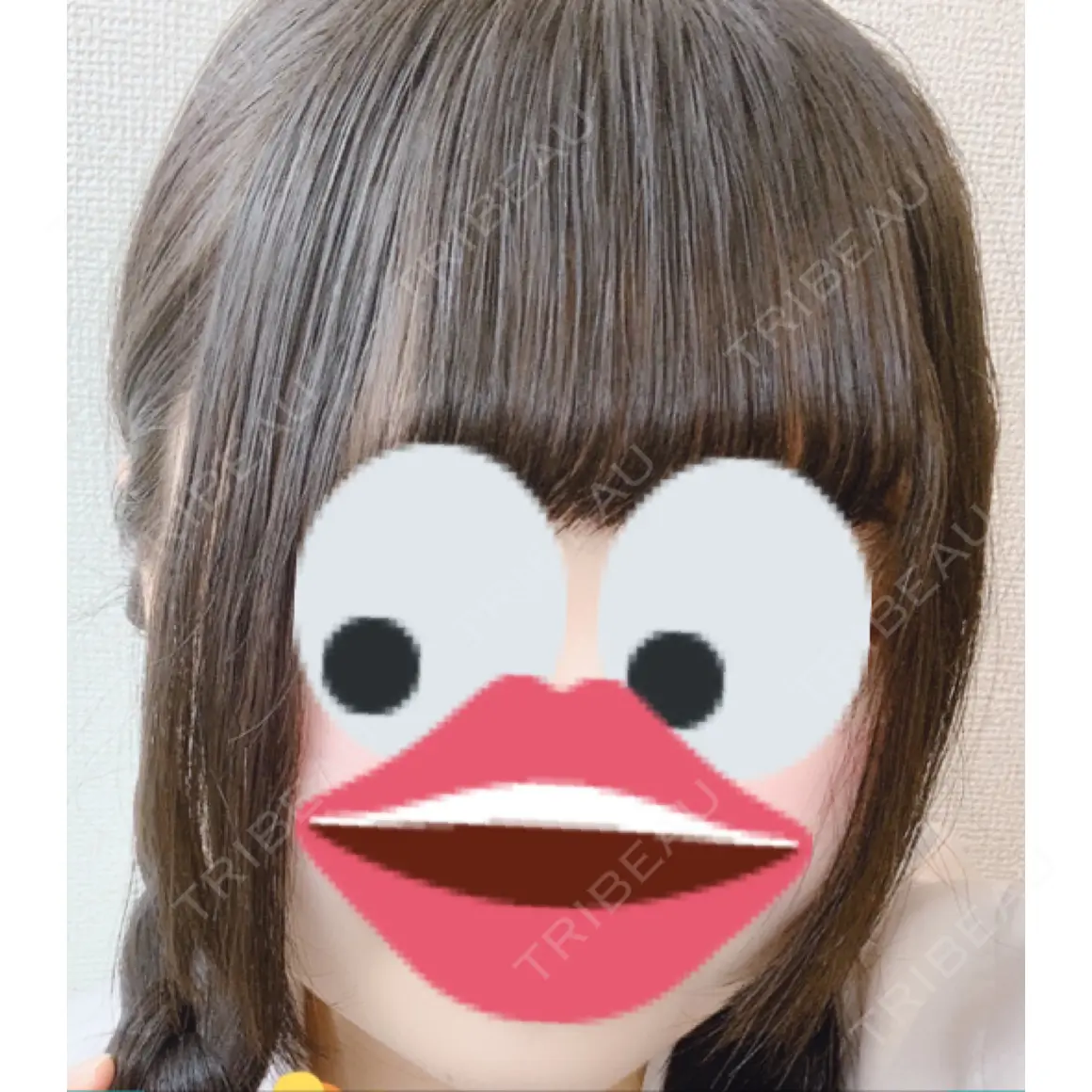 骨切り（あご） / 骨削り（エラ） / 骨削り（頬） / 脂肪吸引（顔） id（アイディ）美容外科 AFTER