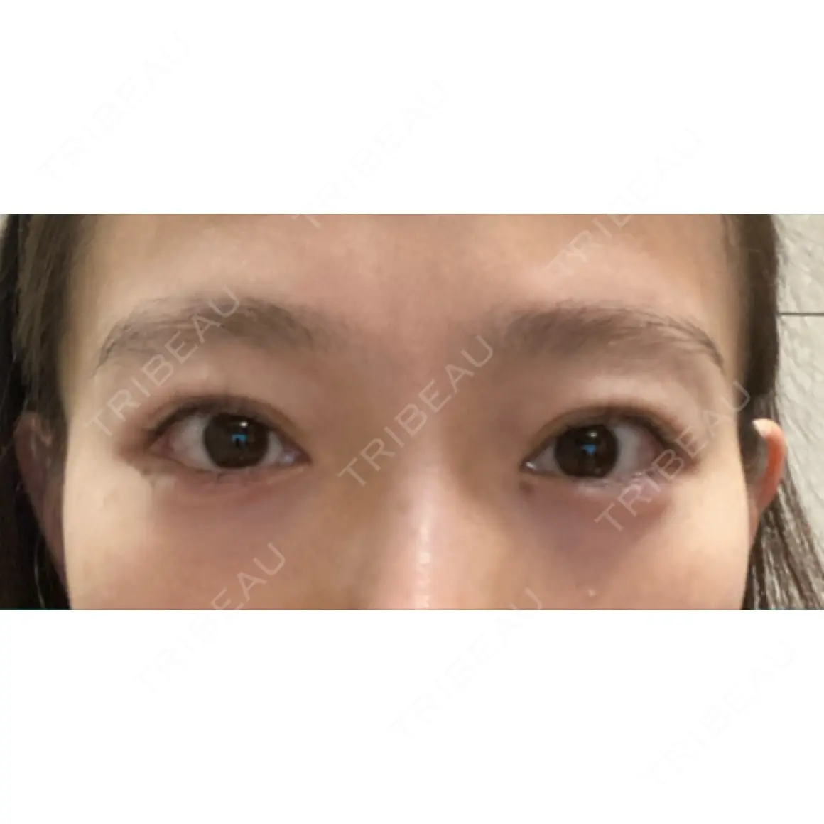 タレ目形成・グラマラスライン（切開） / 自然癒着法 プロミス整形外科 AFTER