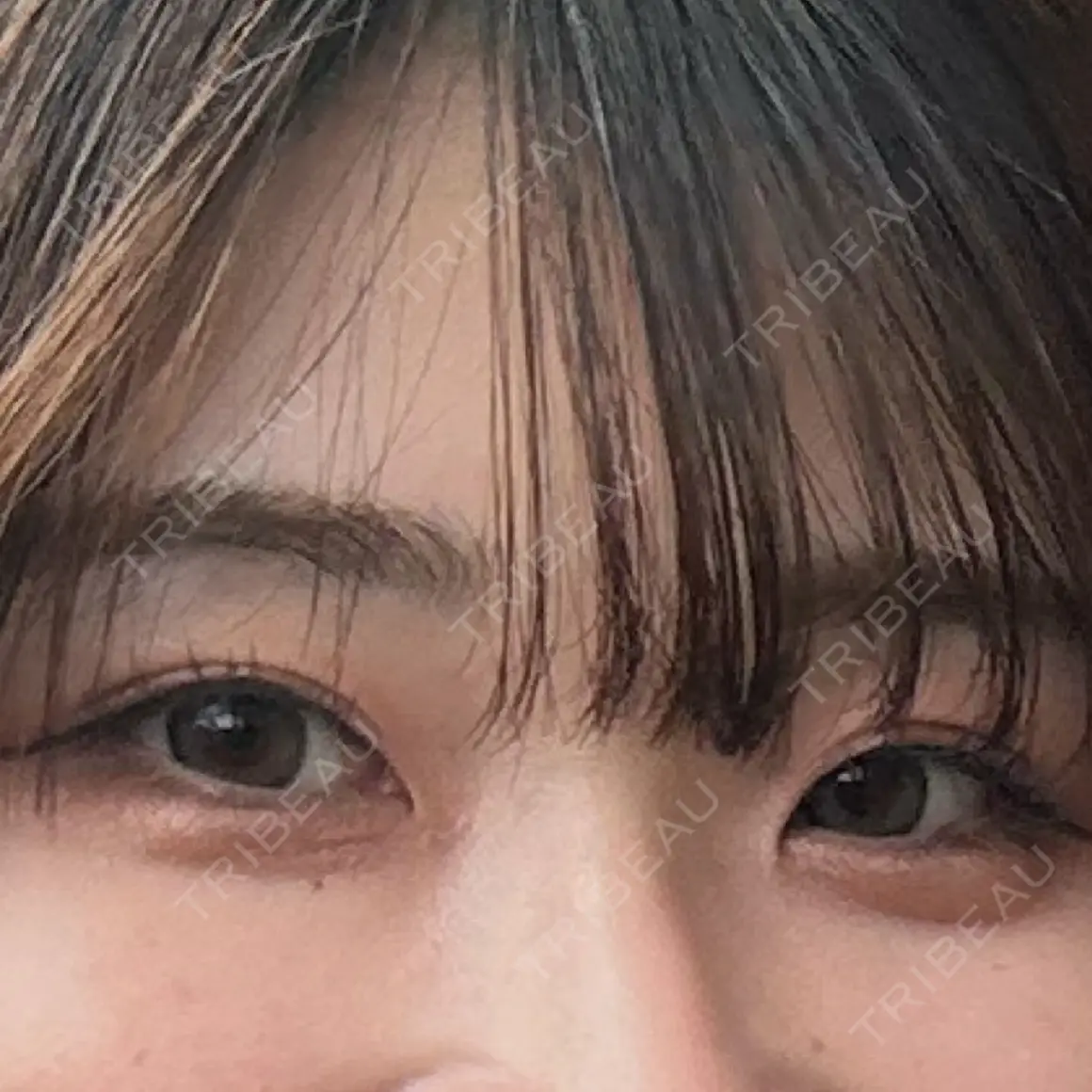 二重埋没 9BeautyClinic AFTER