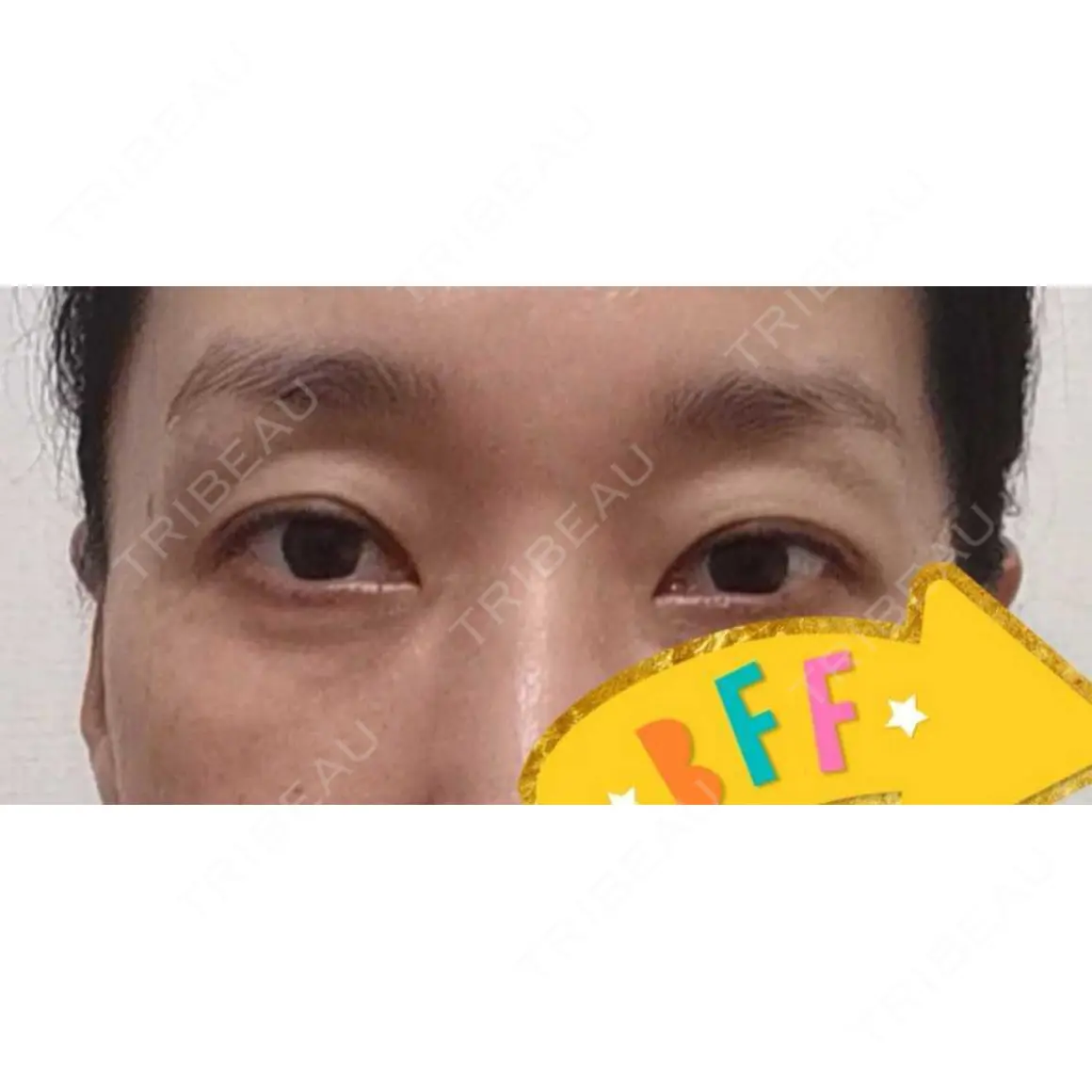 眼瞼下垂（切開） みやび形成外科 AFTER