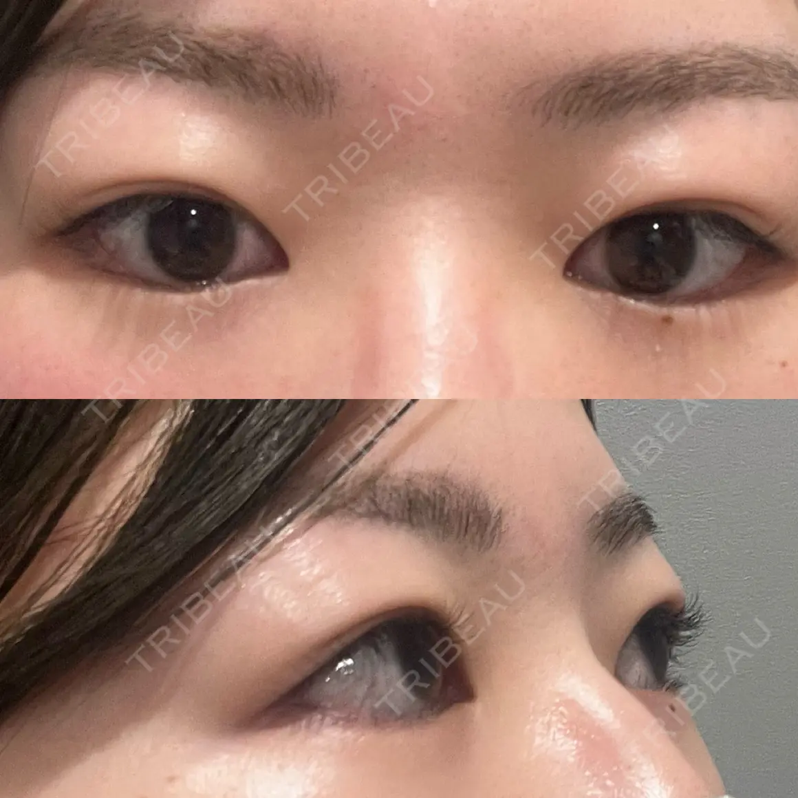 上まぶたの脂肪取り 9BeautyClinic AFTER