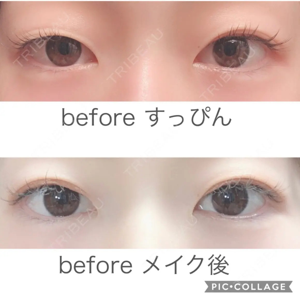 二重埋没 湘南美容クリニック 新宿本院 AFTER