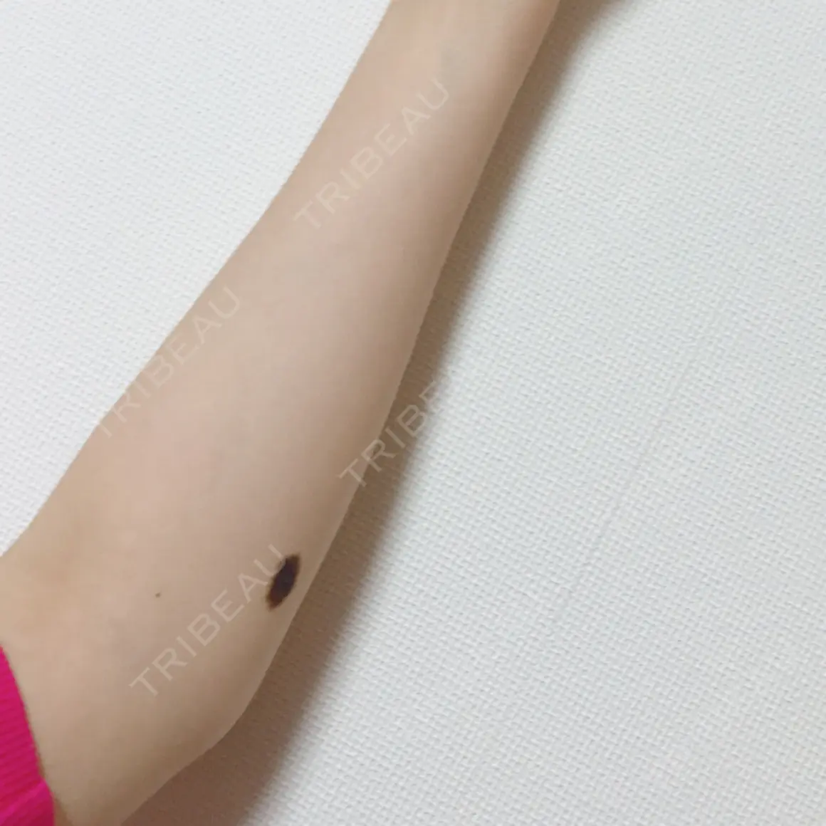 ほくろ・いぼ切除（肌） つかはら皮膚科・形成外科クリニック AFTER