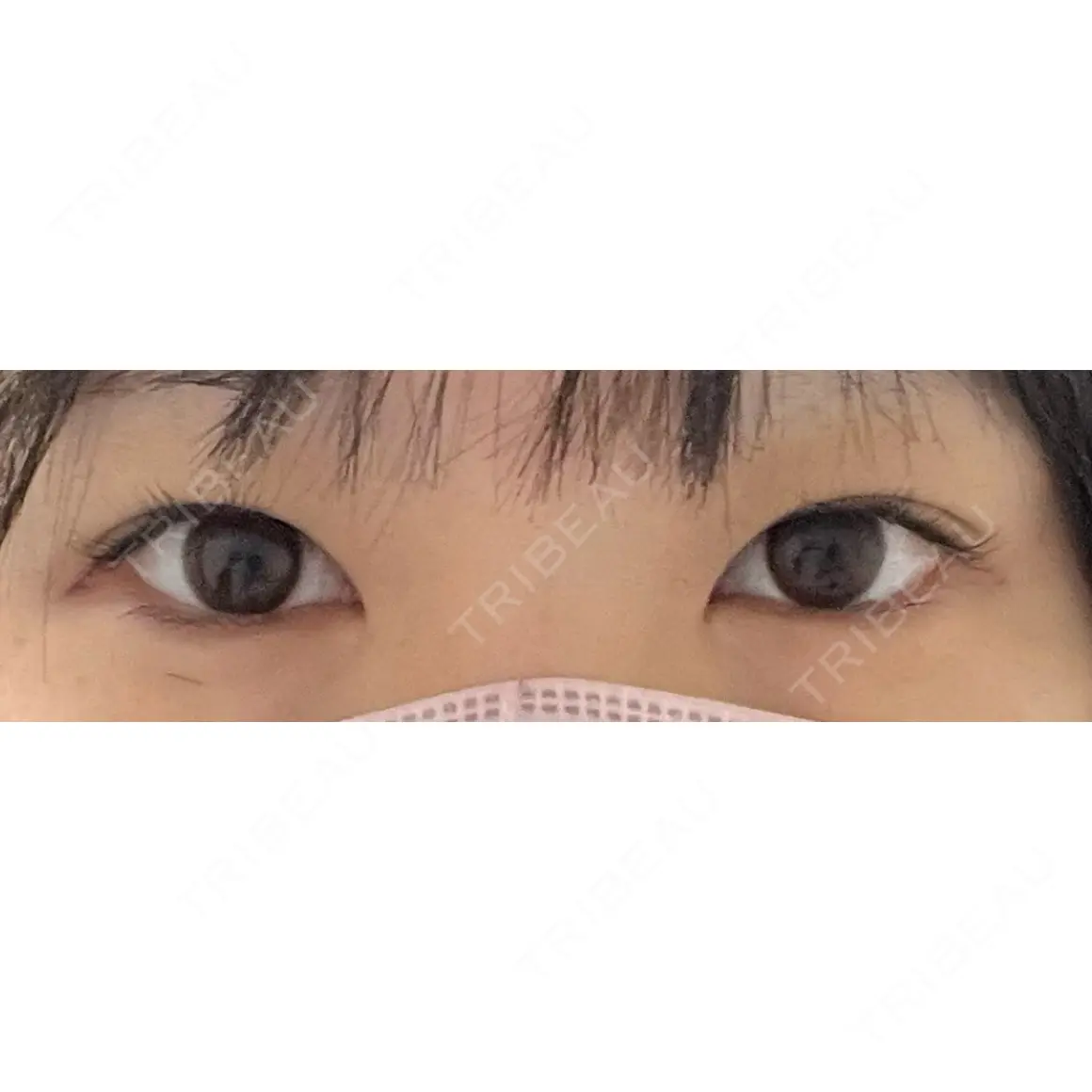 二重埋没 東京形成美容外科 銀座院 AFTER