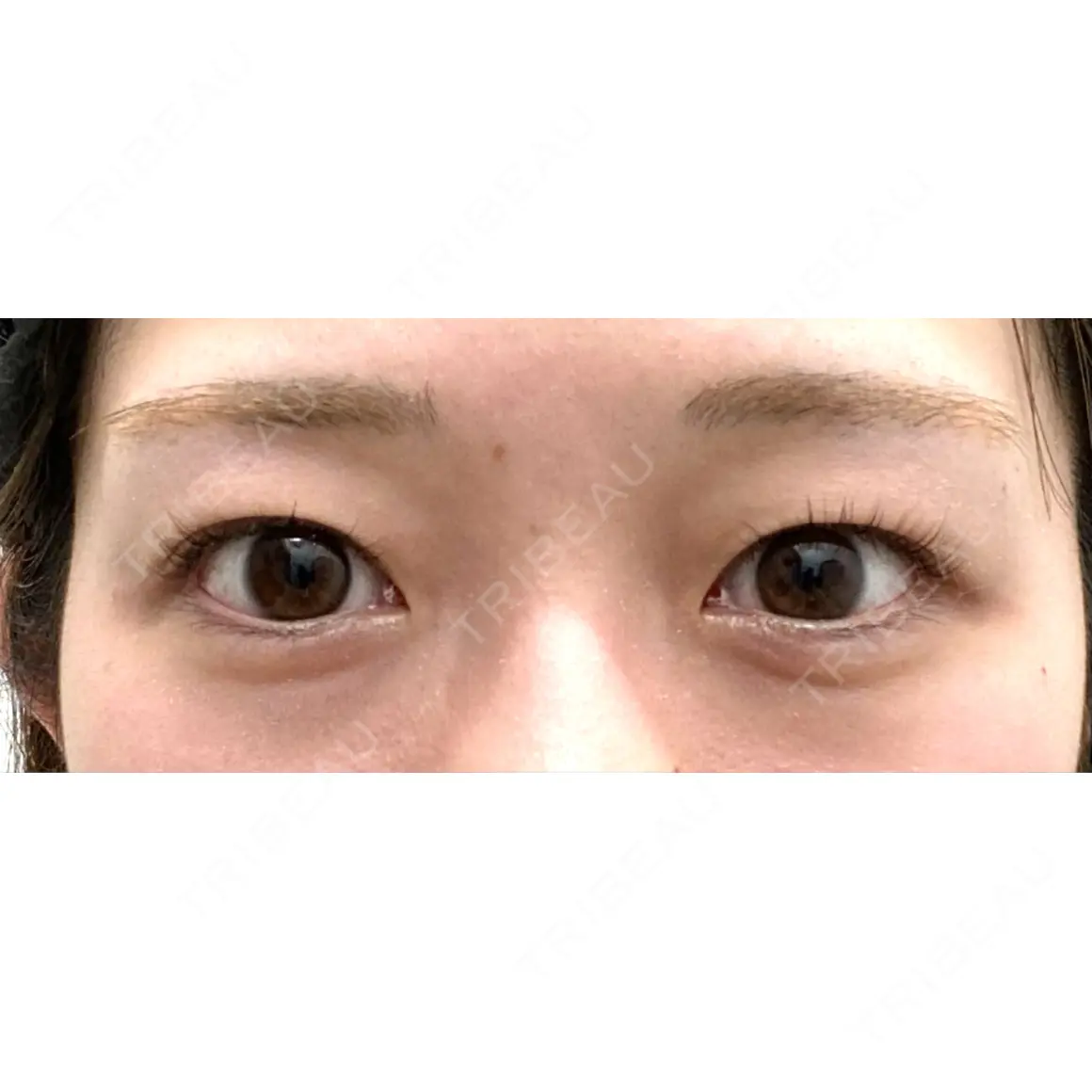 二重埋没 湘南美容クリニック 池袋東口院 AFTER