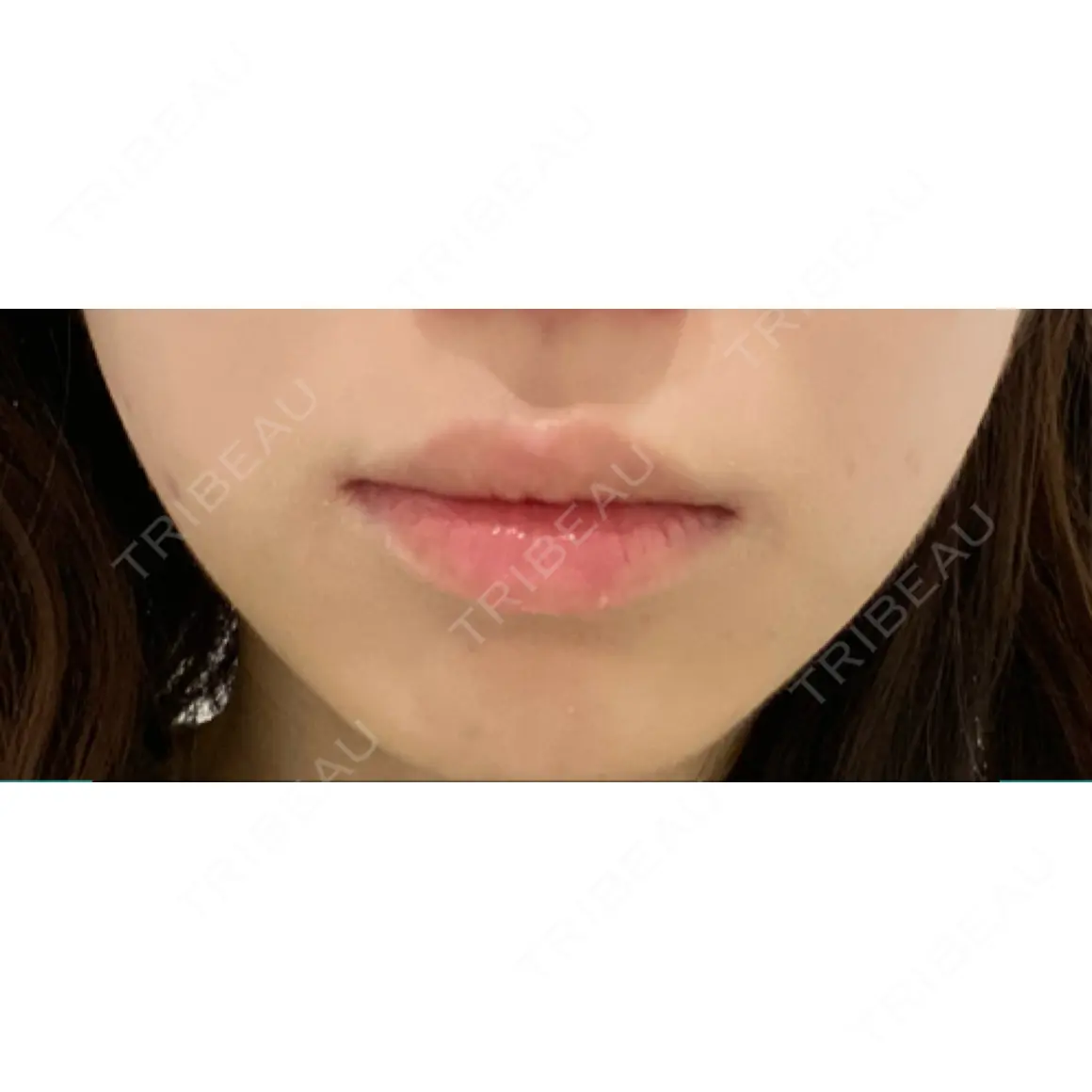 ボトックス（エラ・小顔） TCB東京中央美容外科 立川院 AFTER