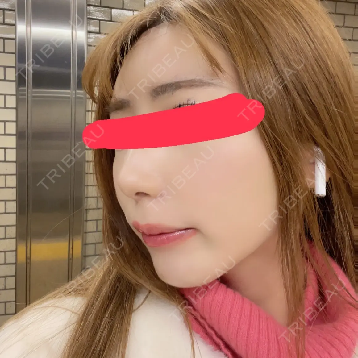 ヒアルロン酸注入（額） ユウコ形成外科クリニック AFTER