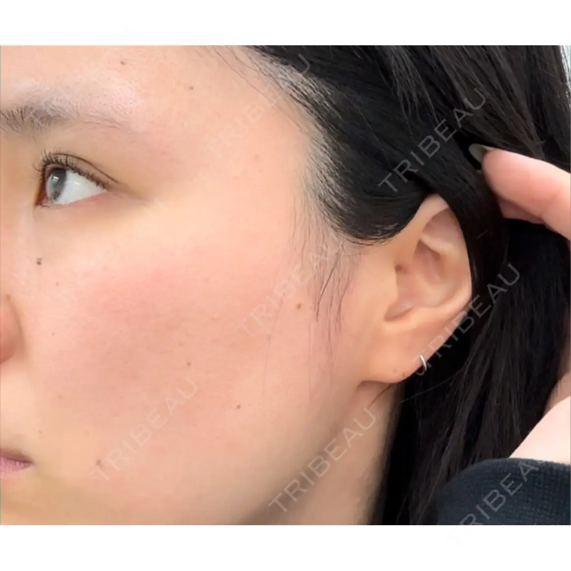 ほくろ・いぼ切除（肌） Jスキンクリニック 【J-SKIN clinic】 AFTER