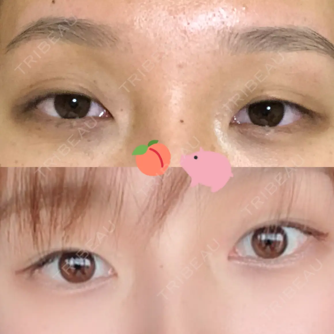 二重埋没 湘南美容クリニック 柏院 AFTER
