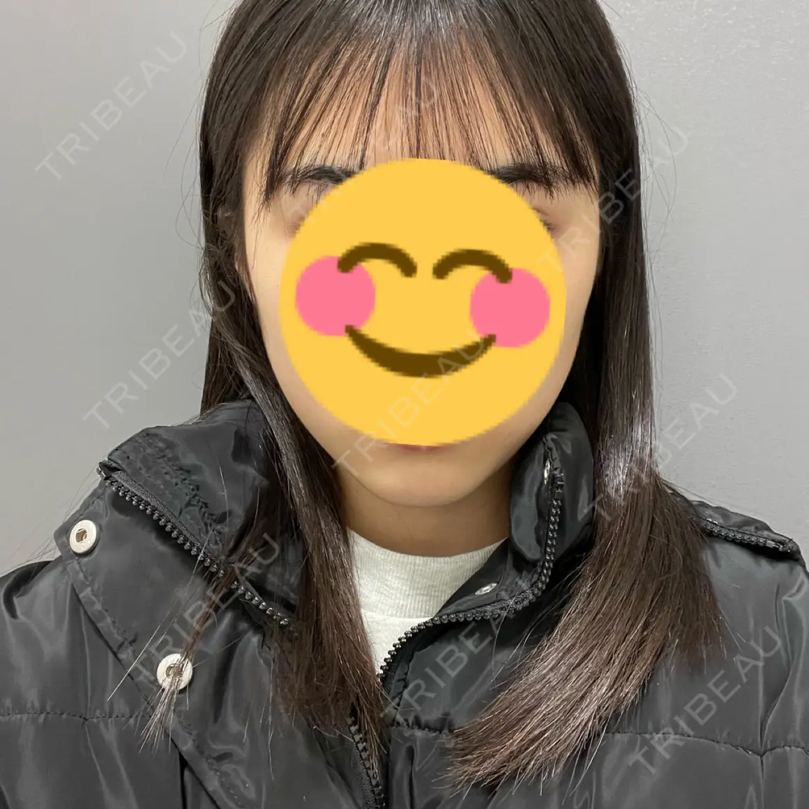 脂肪吸引注射（顔） ziz CLINIC AFTER