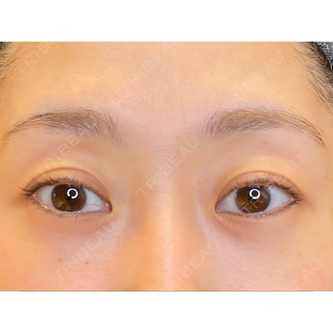 目尻切開 / タレ目形成・グラマラスライン（埋没） / その他（肌） LOUIS CLINIC 二子玉川院【ルイクリニック】 AFTER