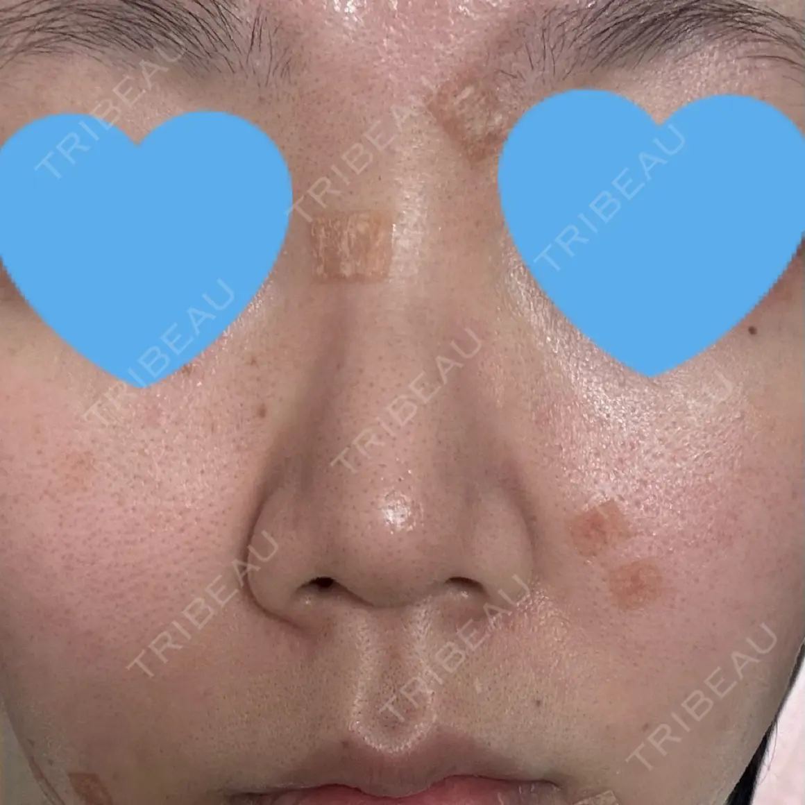 光治療（フォトフェイシャルなど） まゆりなclinic 名古屋栄 AFTER