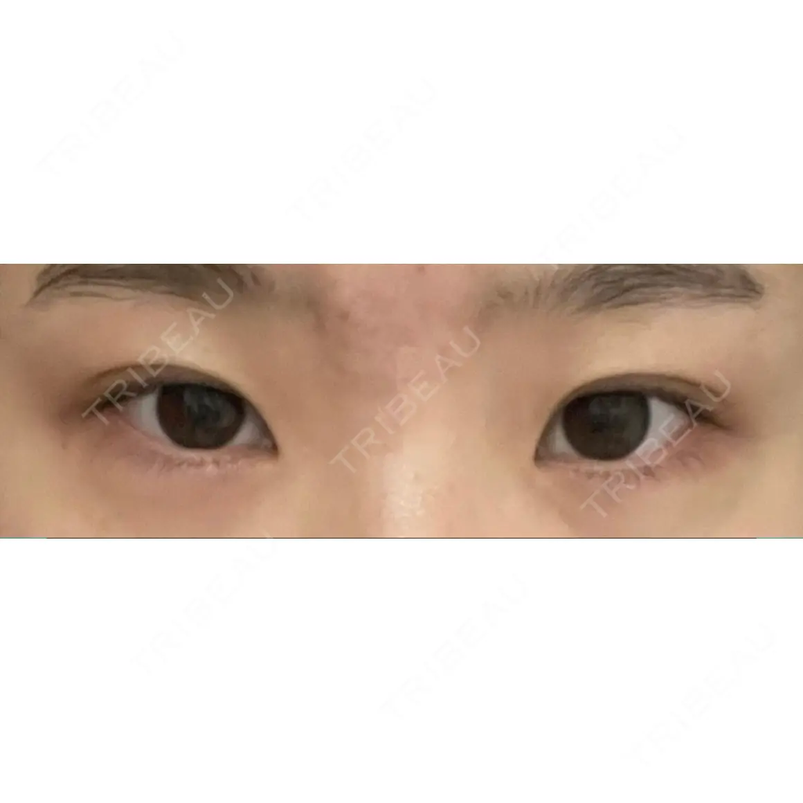 タレ目形成・グラマラスライン（切開） プロミス整形外科 AFTER