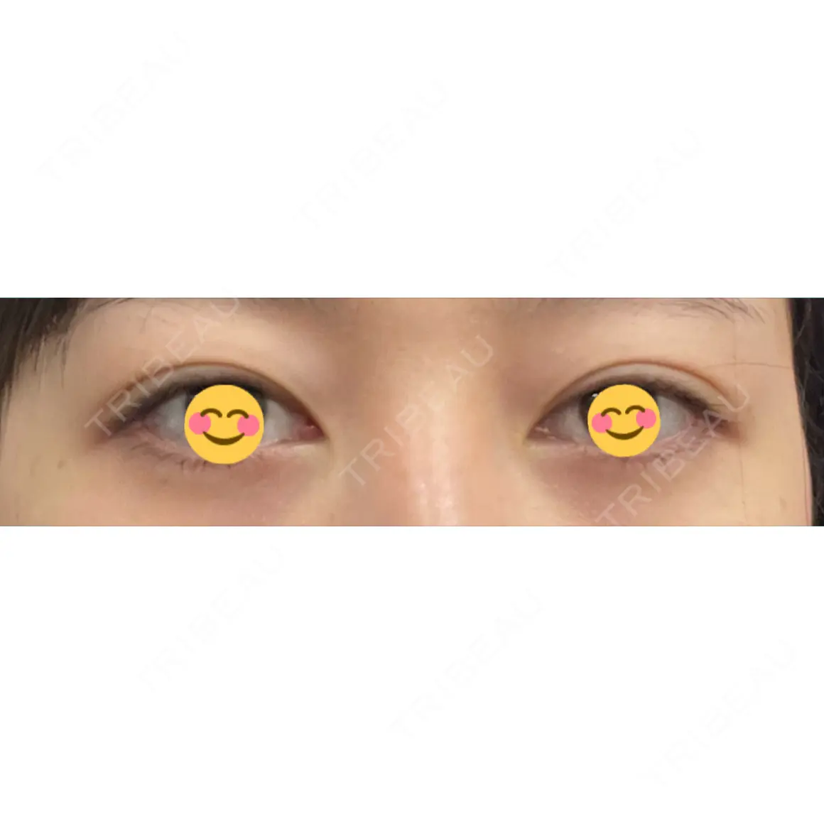 二重切開 / 眼瞼下垂（切開） / 上まぶたたるみ取り / 上まぶたの脂肪取り eクリニック 東京院 AFTER