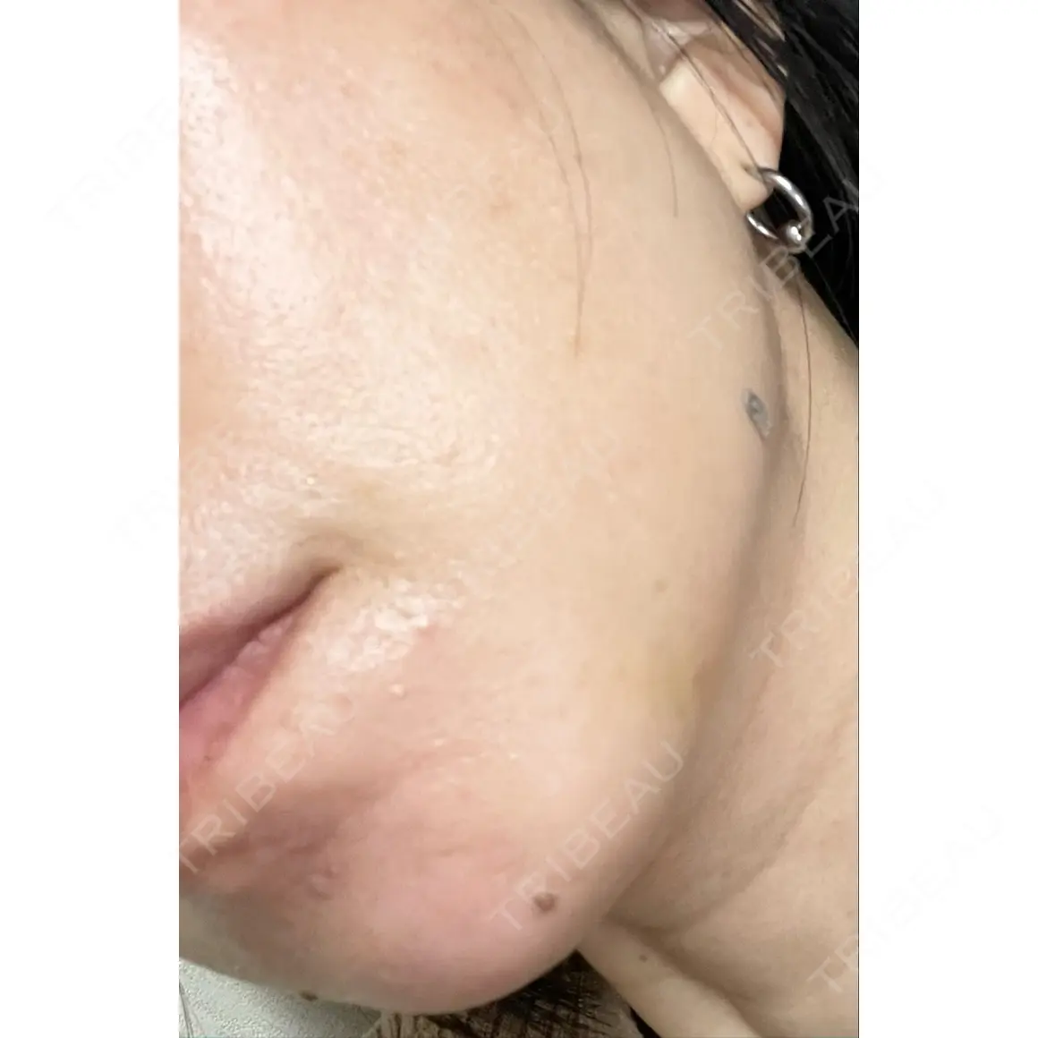 高濃度ビタミンC点滴 美容皮膚科エルムクリニック 広島院 AFTER
