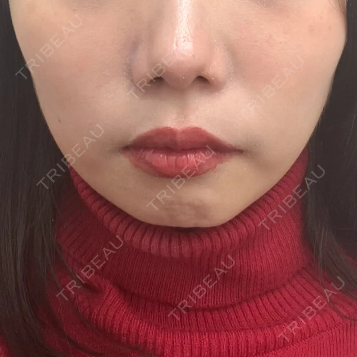 脂肪溶解注射（顔） TCB東京中央美容外科 本厚木院 AFTER