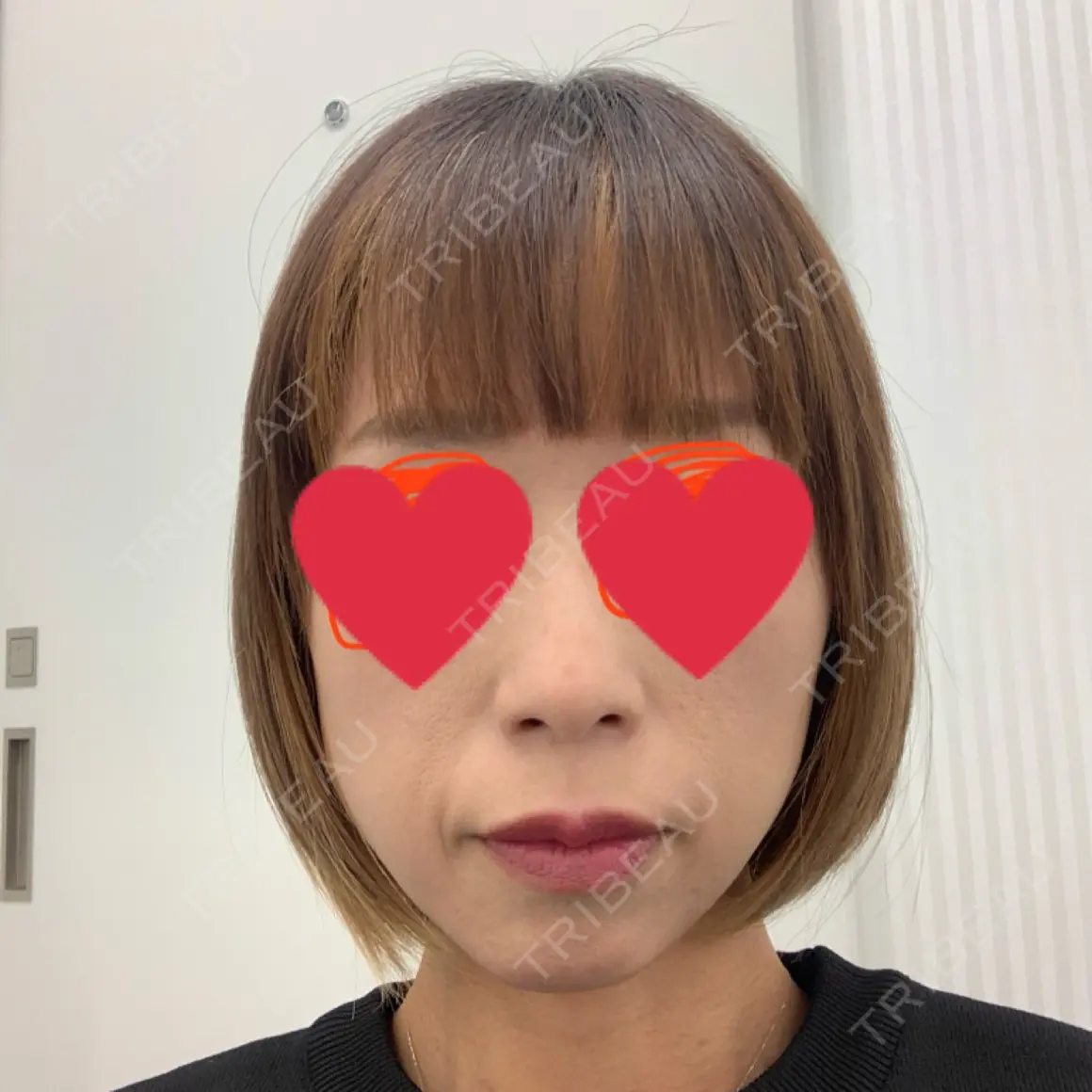 肌ヒアルロン酸注入（たるみ・シワ改善） TCB東京中央美容外科 松江院 AFTER