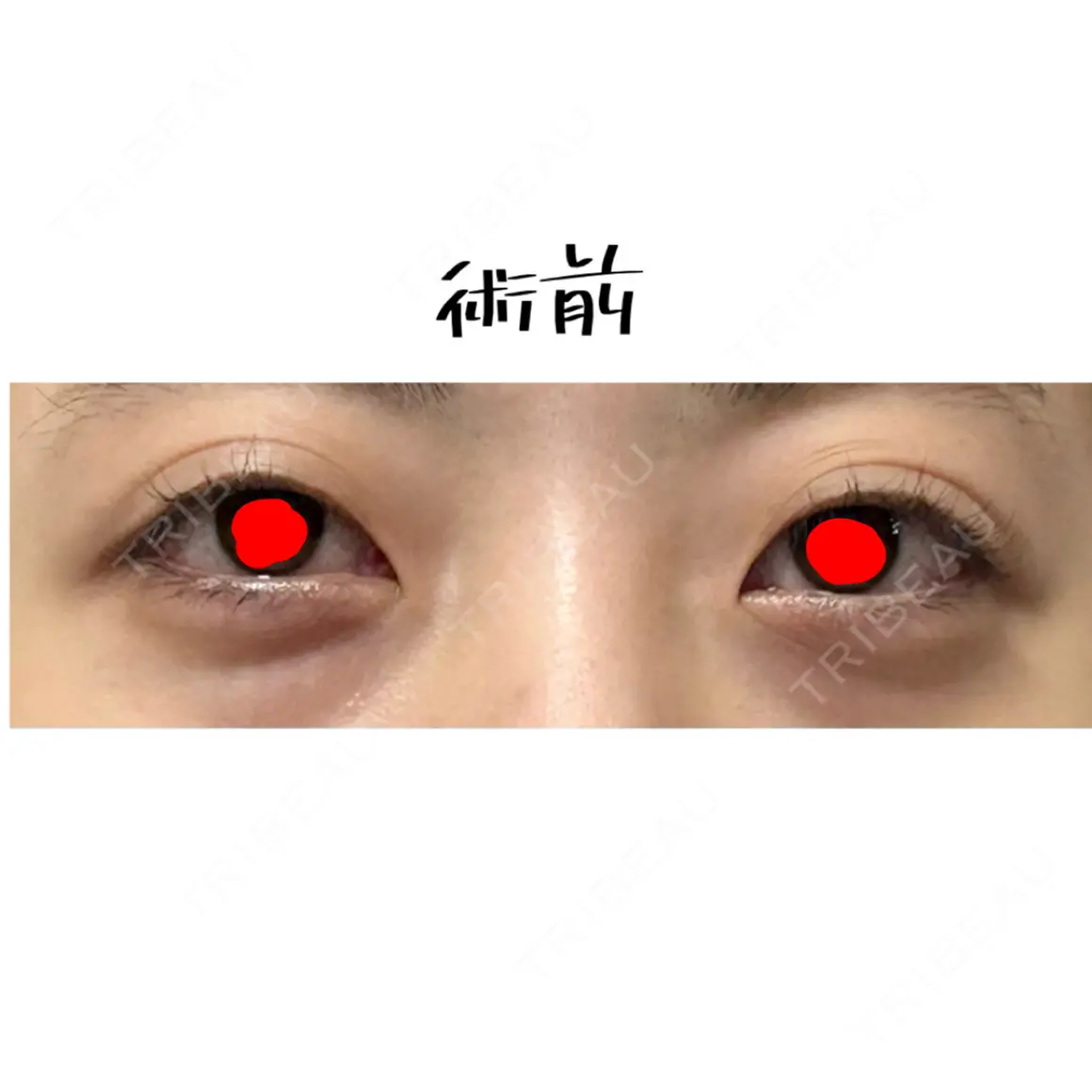 二重埋没 / 目頭切開 / 目尻切開 / タレ目形成・グラマラスライン（切開） / 眼瞼下垂（非切開） LUHO（ルホ）美容外科 AFTER