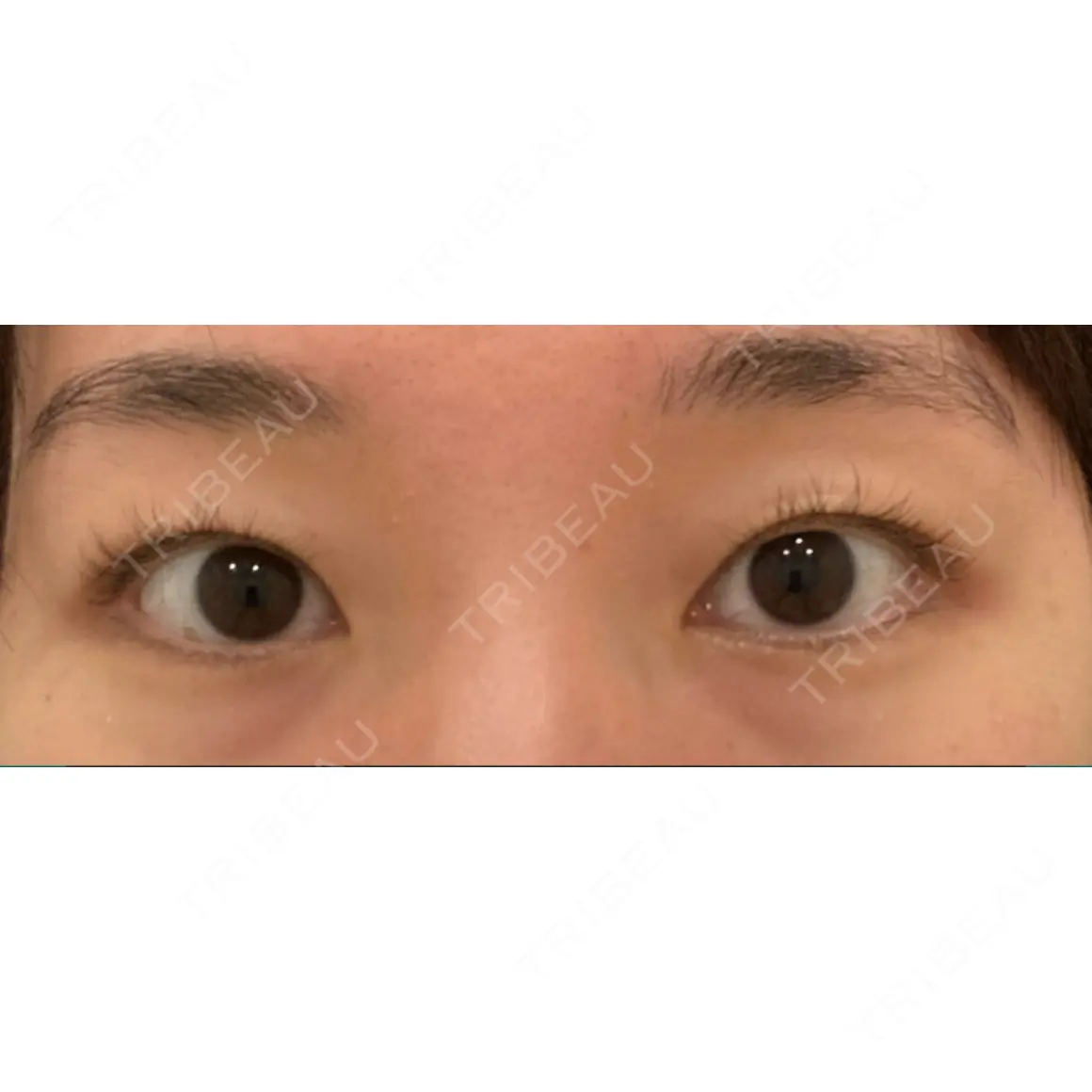 二重埋没 オアシス美容外科 AFTER