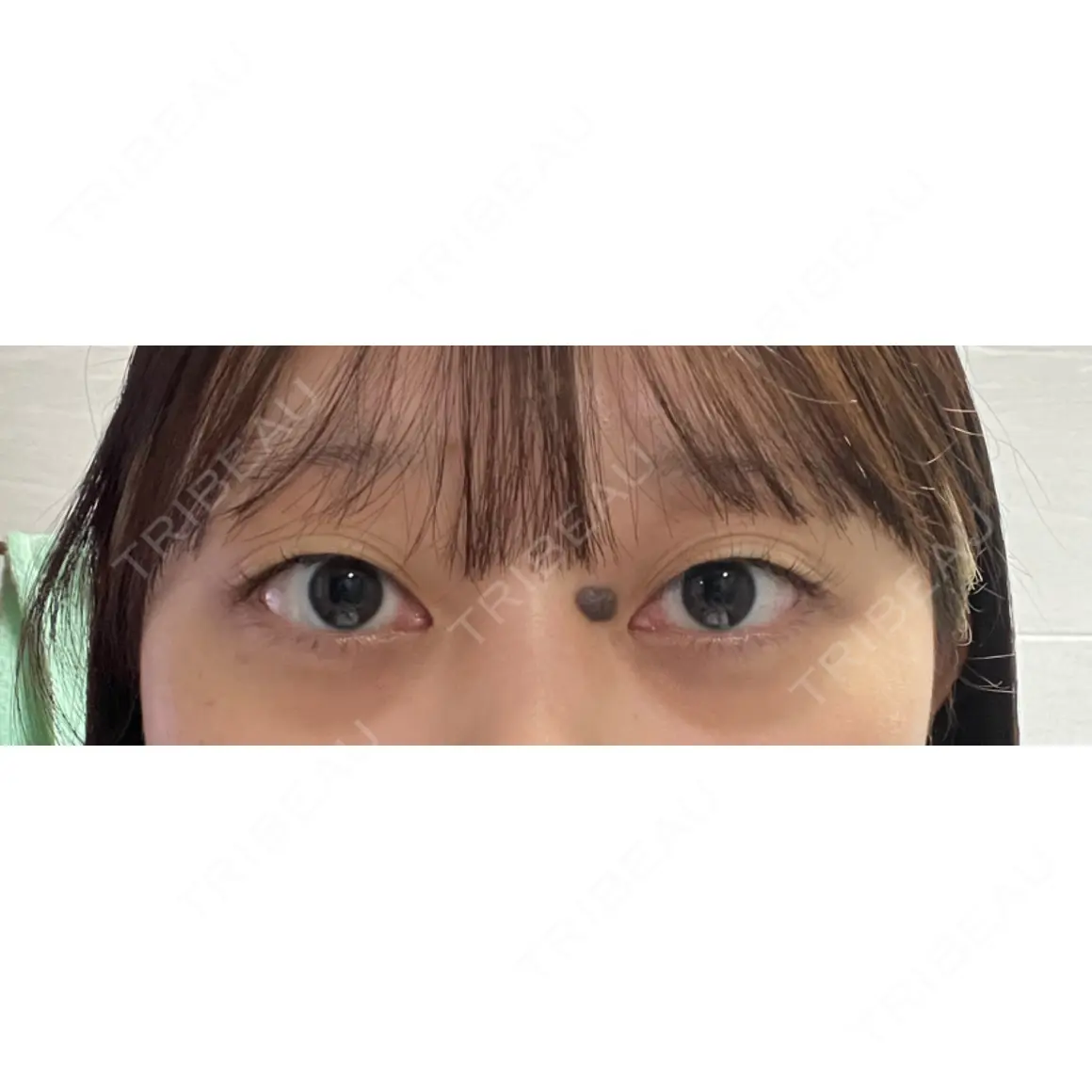二重埋没 LUHO（ルホ）美容外科 AFTER