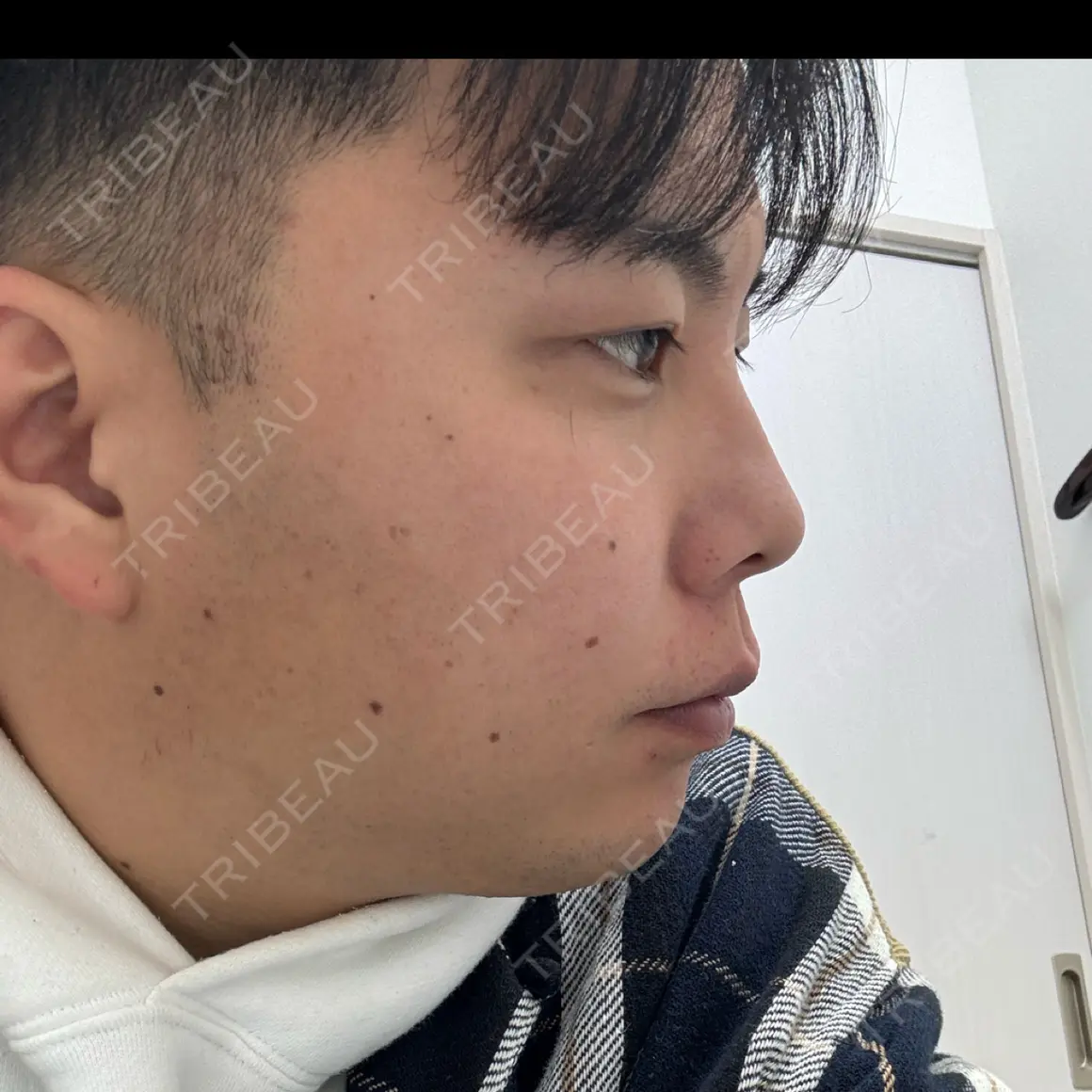 ヒアルロン酸注入（あご） 銀座美容外科クリニック 新宿院 AFTER