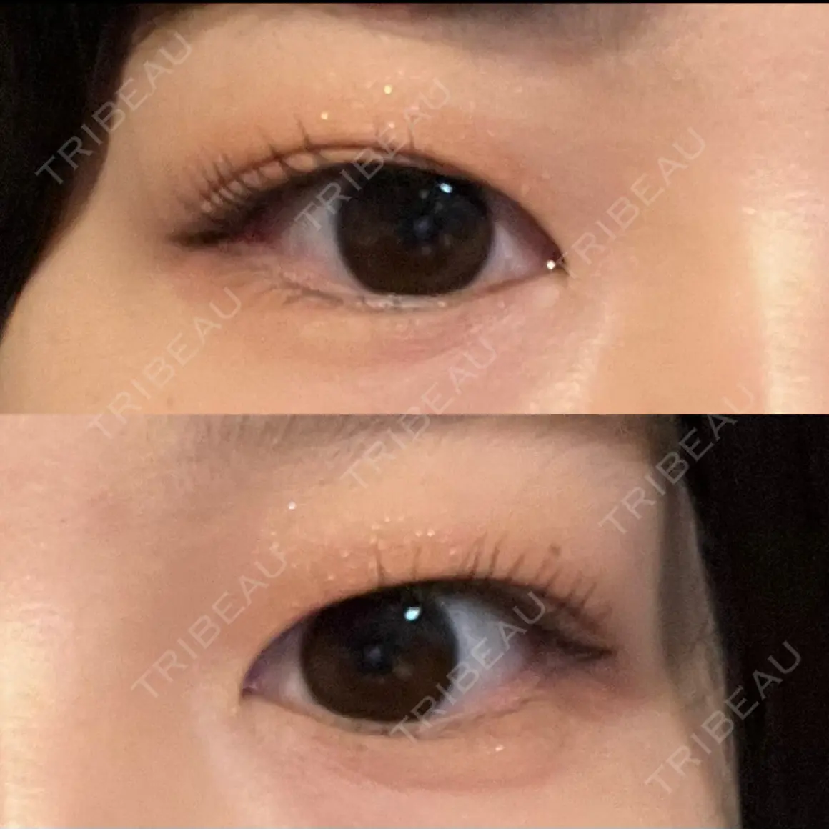 二重埋没 / 上まぶたの脂肪取り HAAB×DREAM BEAUTY CLINIC 東京本院 AFTER