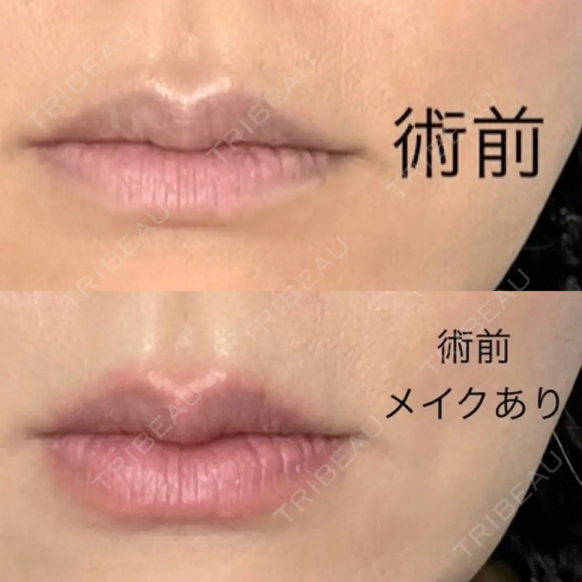 ヒアルロン酸注入（唇） / ボトックス（口角） ルラ美容クリニック 福岡院 AFTER