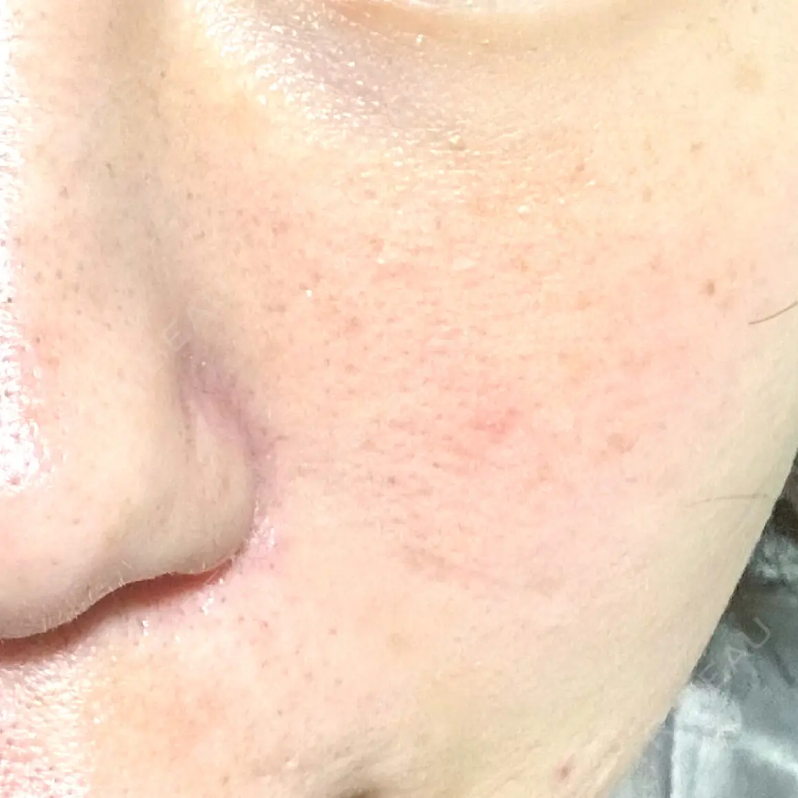 光治療（フォトフェイシャルなど） B-LINE CLINIC 池袋院 AFTER