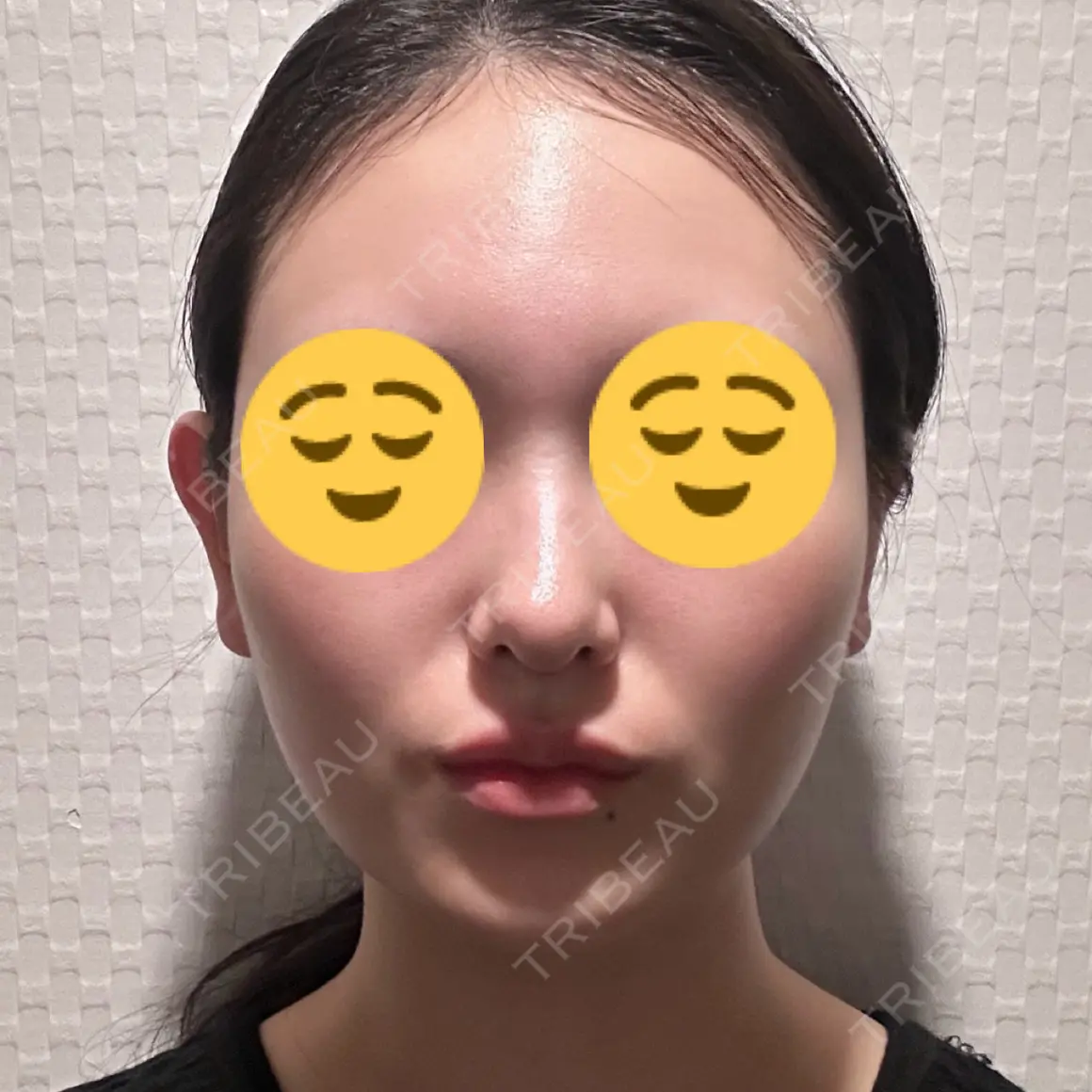 糸リフト / 脂肪吸引（顔） ブルームクリニック（BLOOM CLINIC） AFTER
