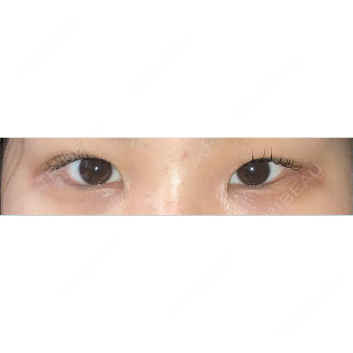 タレ目形成・グラマラスライン（切開） Olino美容外科・美容皮膚科 AFTER