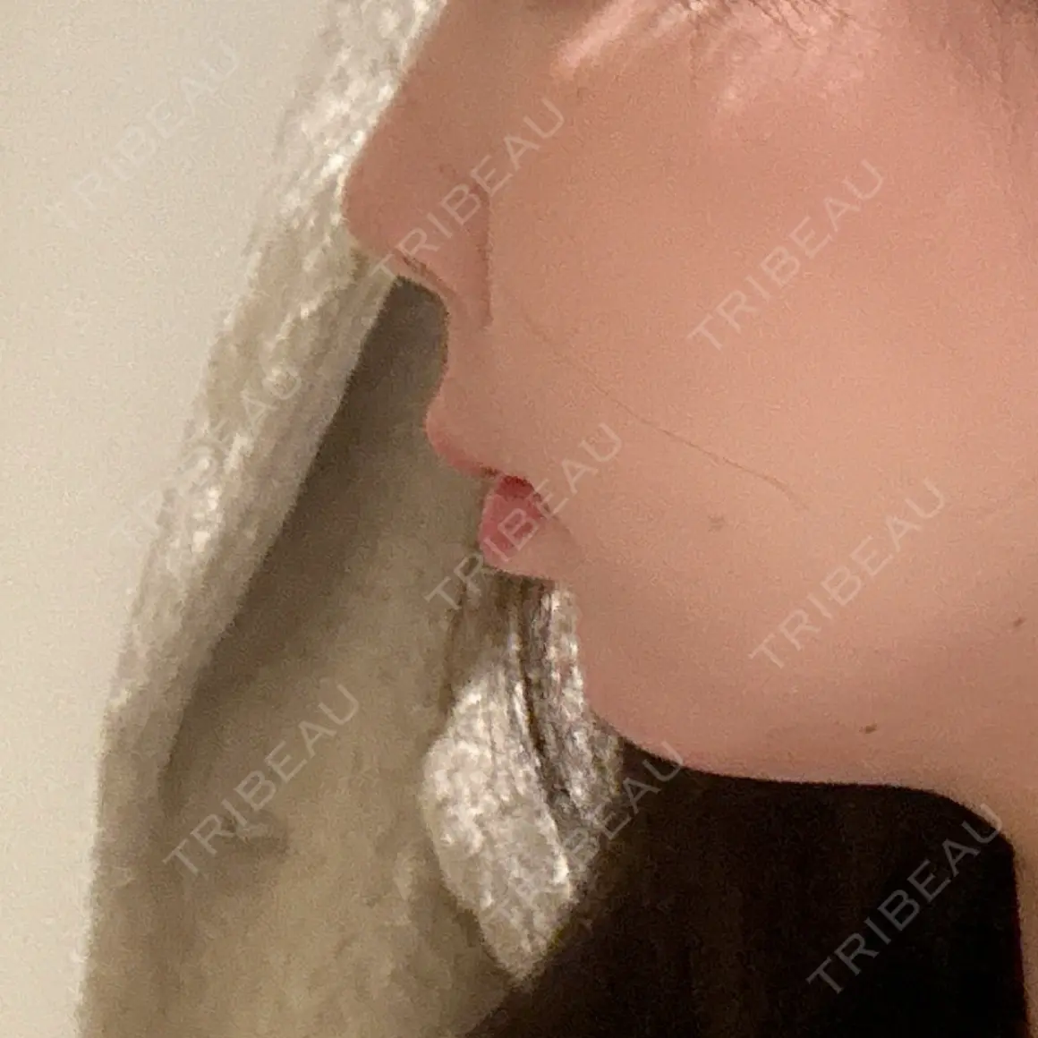 鼻尖形成（切開） / 軟骨移植 / 骨切幅寄せ 9BeautyClinic AFTER