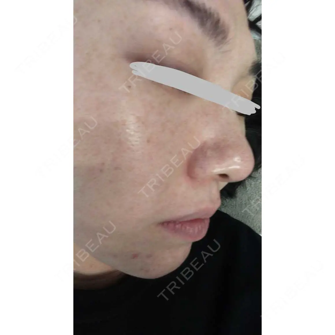 ポテンツァ 9BeautyClinic AFTER