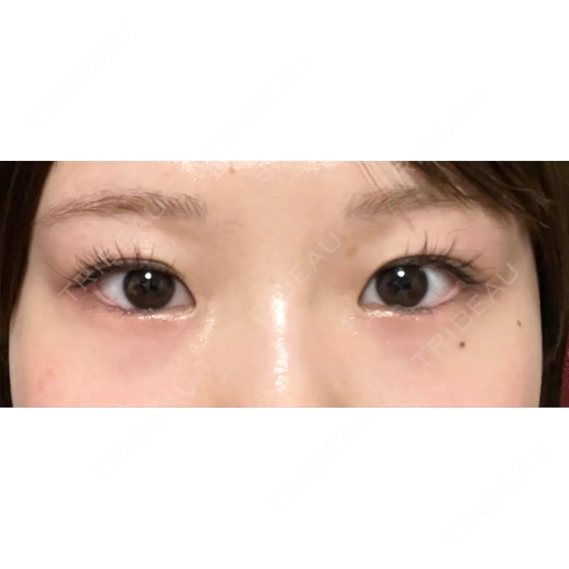 二重切開 / 目頭切開 / 目尻切開 / タレ目形成・グラマラスライン（切開） / 目元修正 LUHO（ルホ）美容外科 AFTER