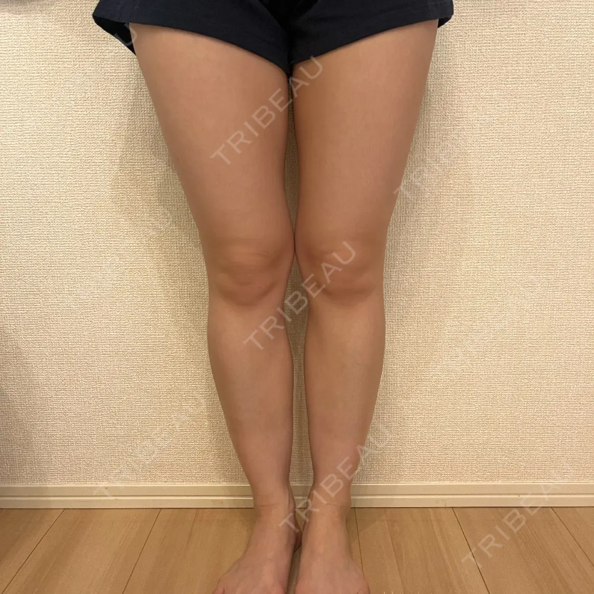 脂肪吸引（脚） 湘南美容クリニック 京都院 AFTER