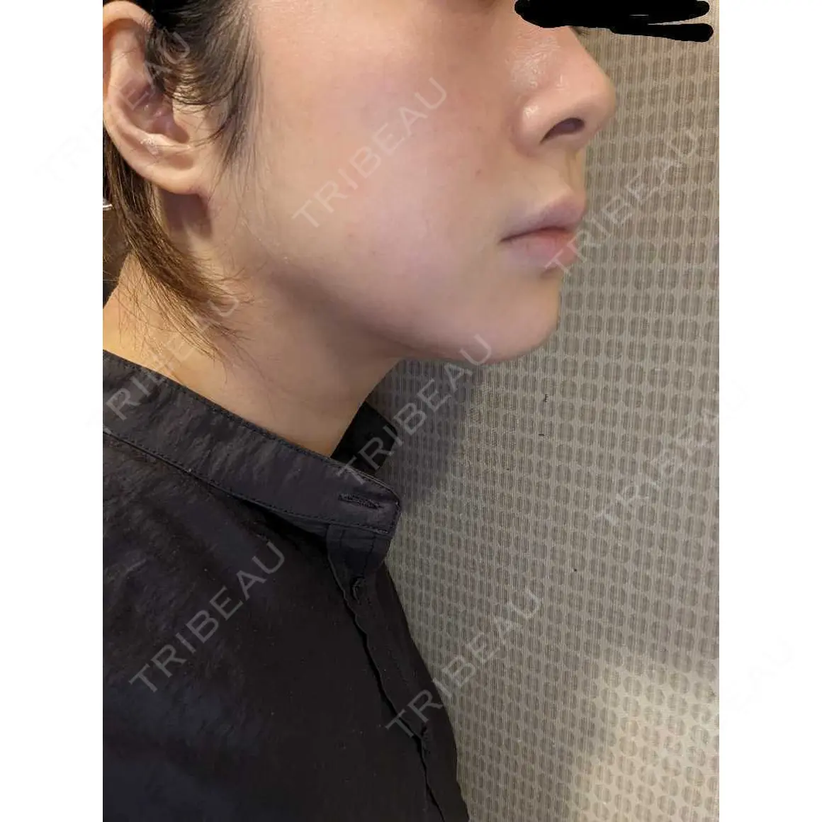 エレクトロポレーション / ルメッカ B-LINE CLINIC 池袋院 AFTER