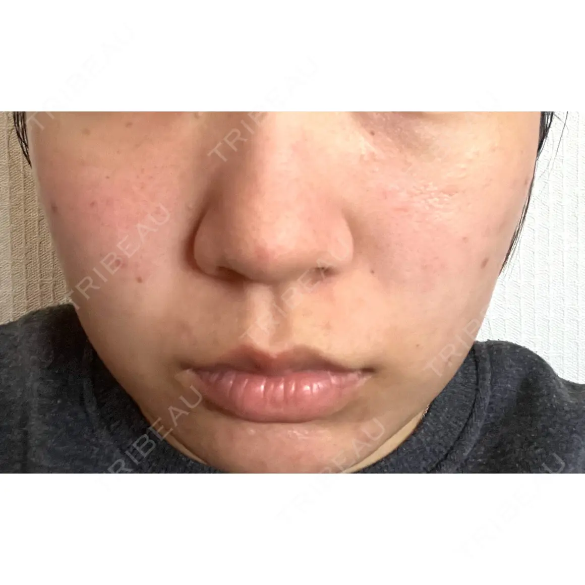 ダーマペン / 毛穴洗浄（ハイドラフェイシャルなど） B-LINE CLINIC 池袋院 AFTER