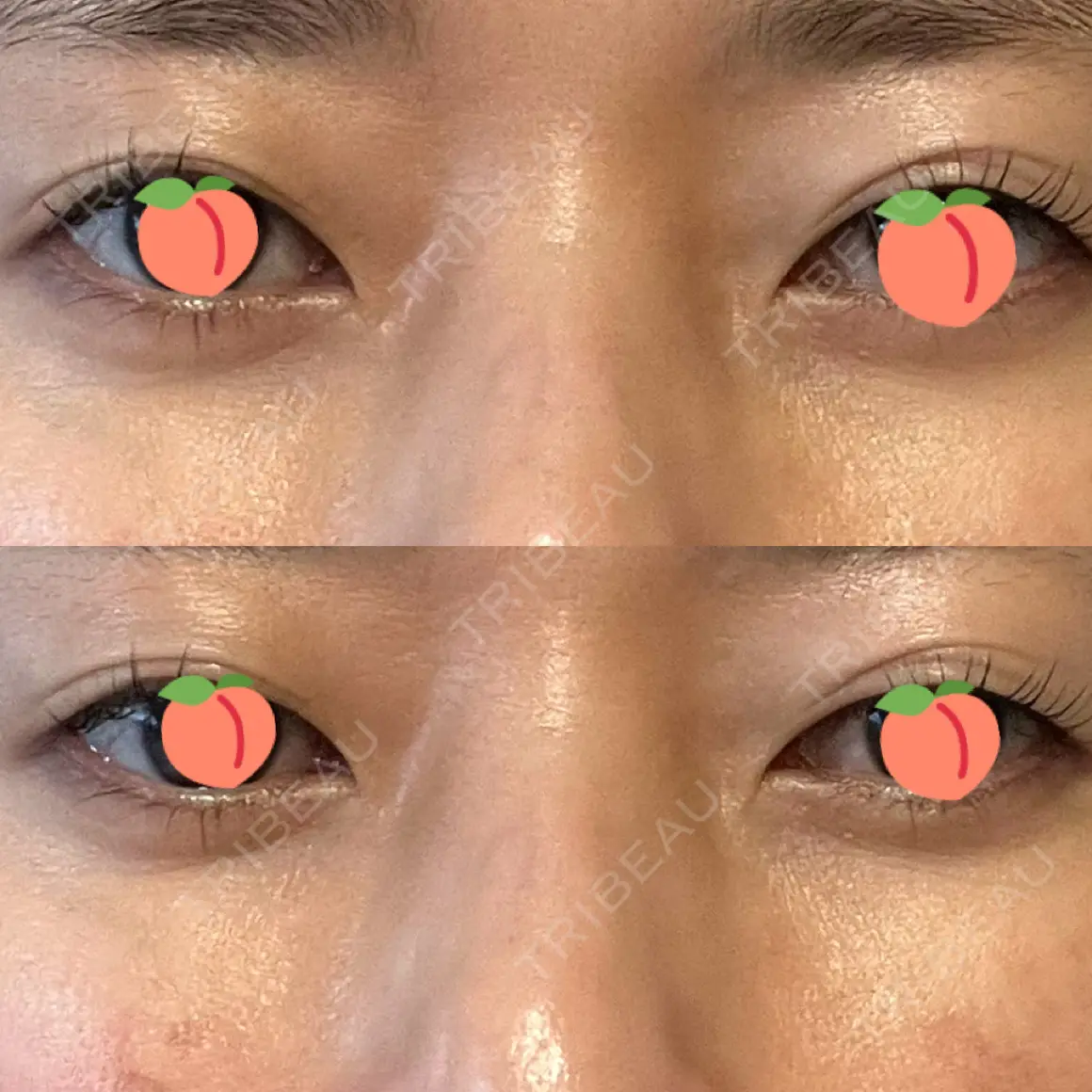 二重埋没 お茶の水美容形成クリニック AFTER