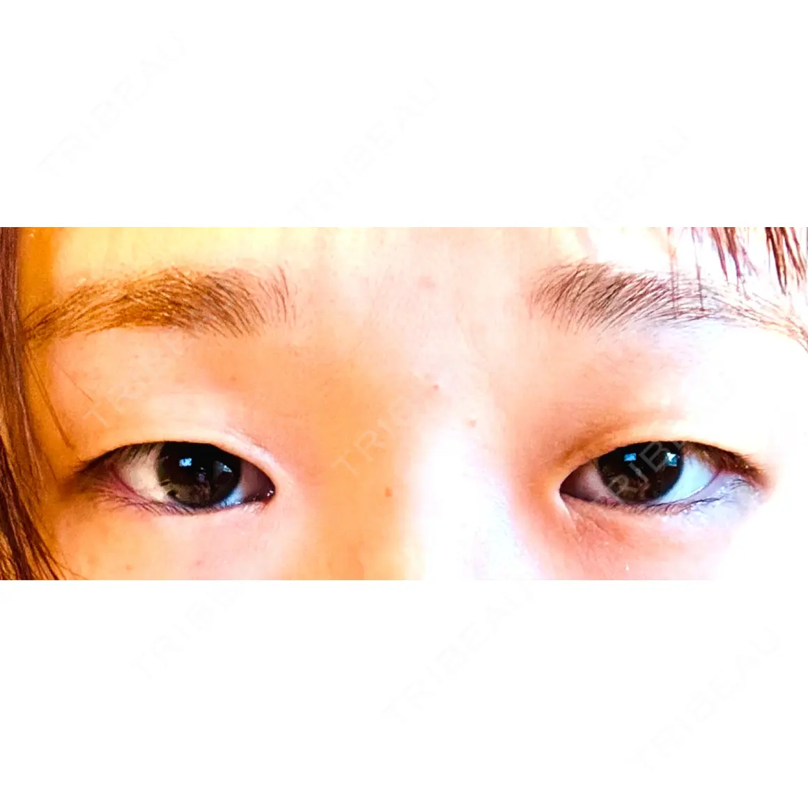 目頭切開 / 自然癒着法 / 眼瞼下垂（非切開） LUHO（ルホ）美容外科 AFTER