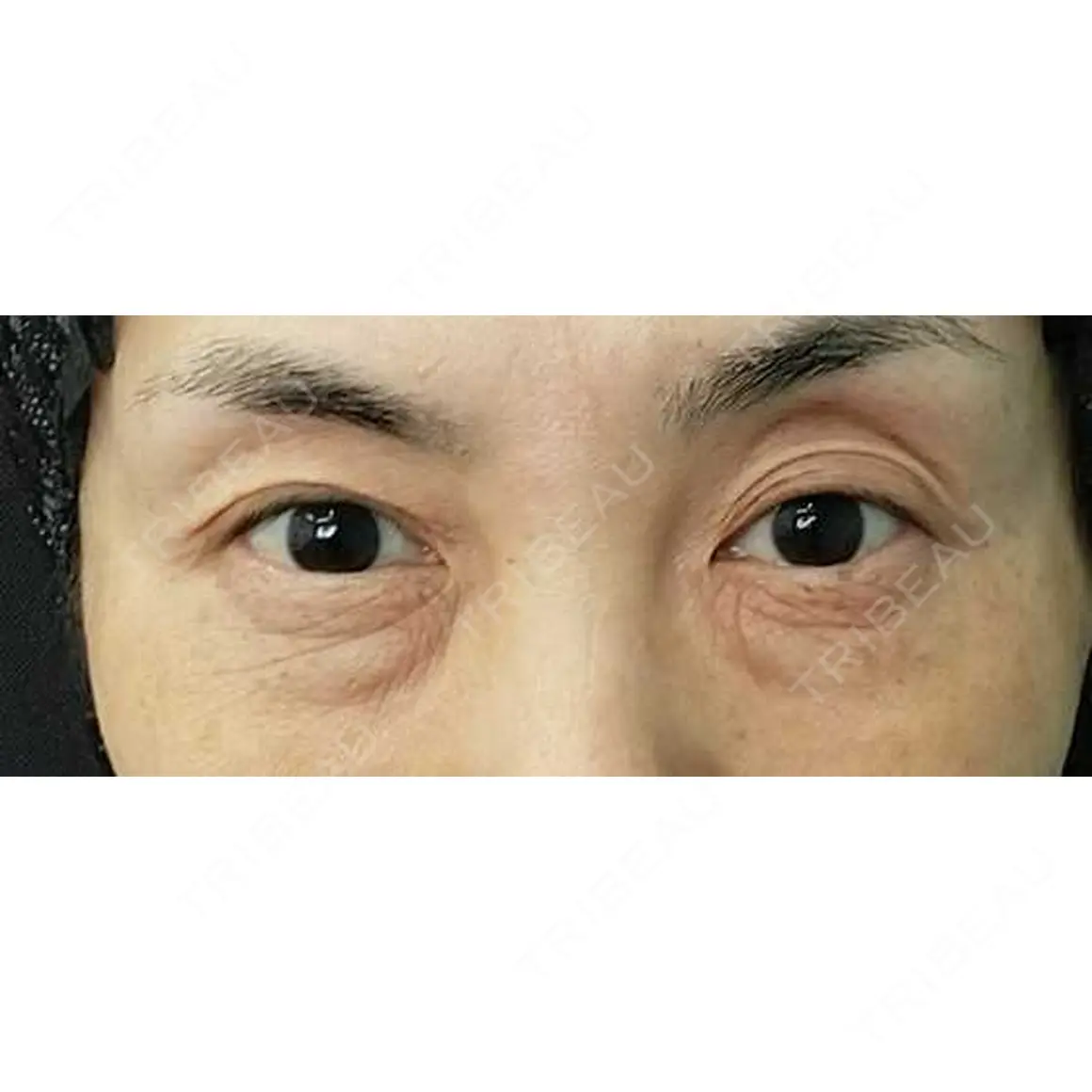 下まぶたの脂肪取り / 脂肪注入（目の下） 湘南美容クリニック 千葉センシティ院 AFTER