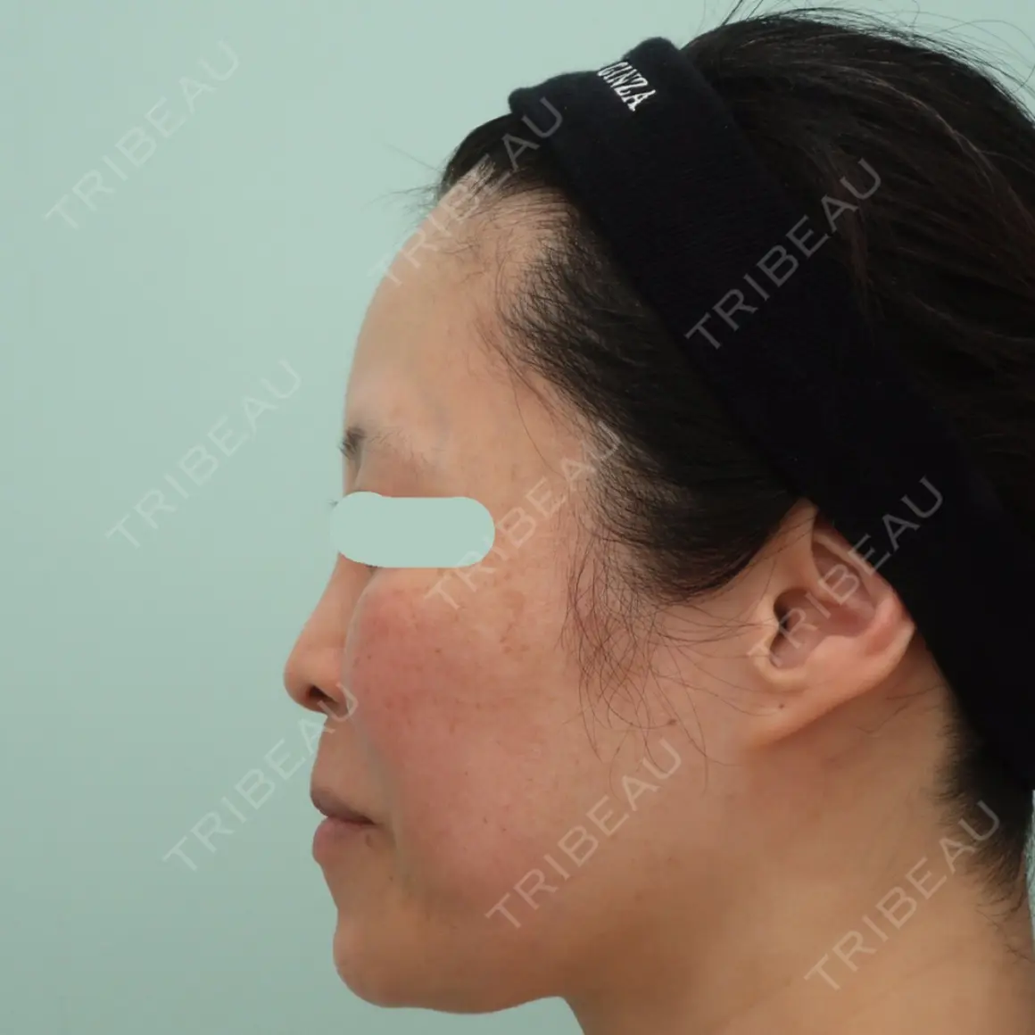 鼻尖形成（切開） / 鼻中隔延長（切開） / 軟骨移植 WOM CLINIC GINZA （ワム クリニック ギンザ） AFTER