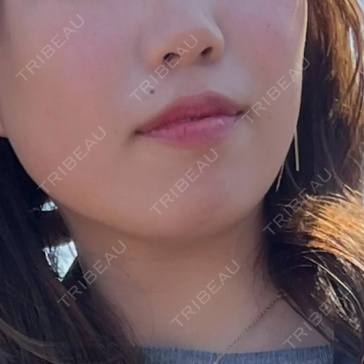 ヒアルロン酸注入（あご） / ボトックス（エラ・小顔） ルラ美容クリニック 町田院 AFTER